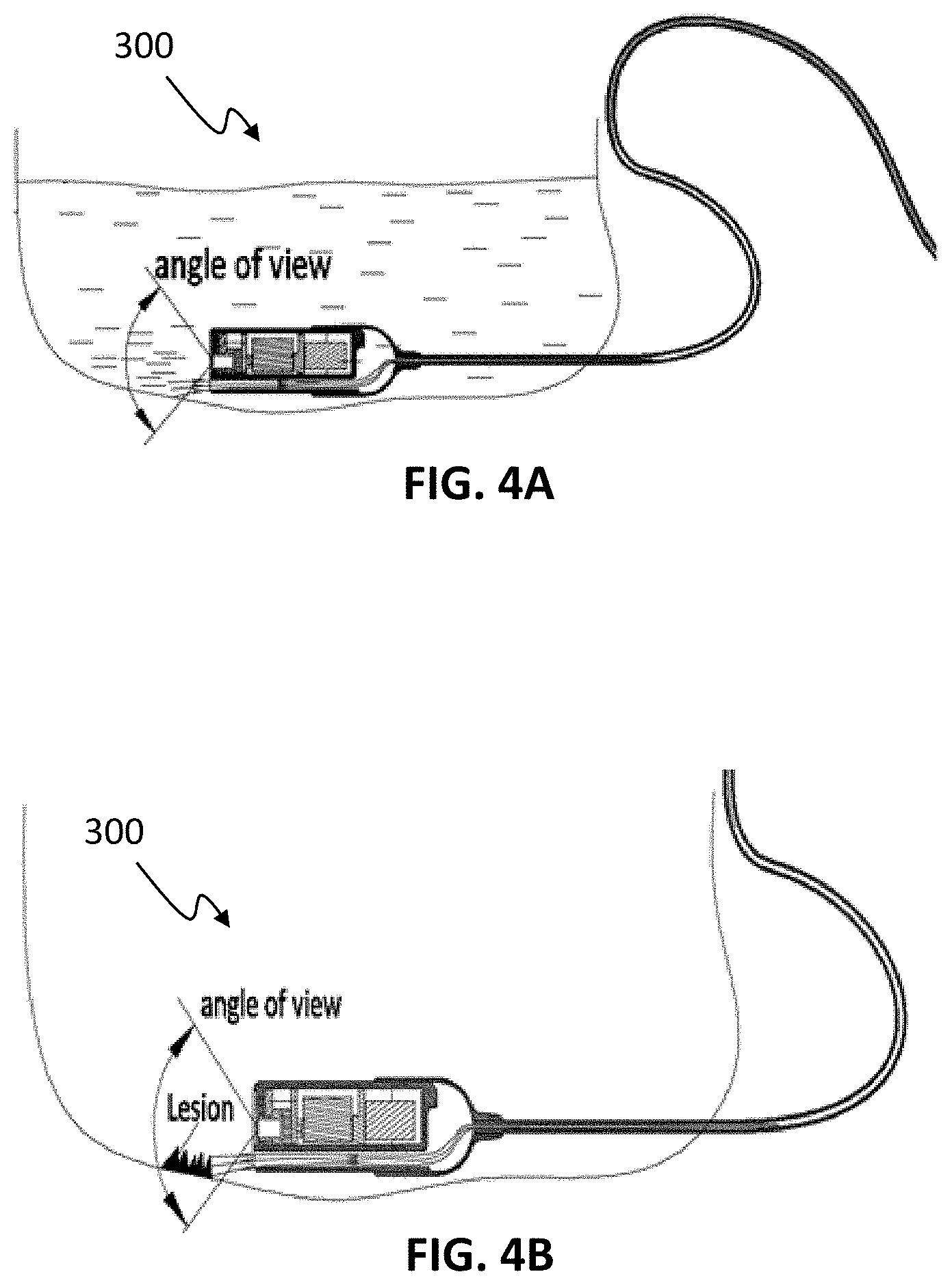 Patent US11771311 Figure 4 – Systems and methods for collecting and screening of pancreatic secretions