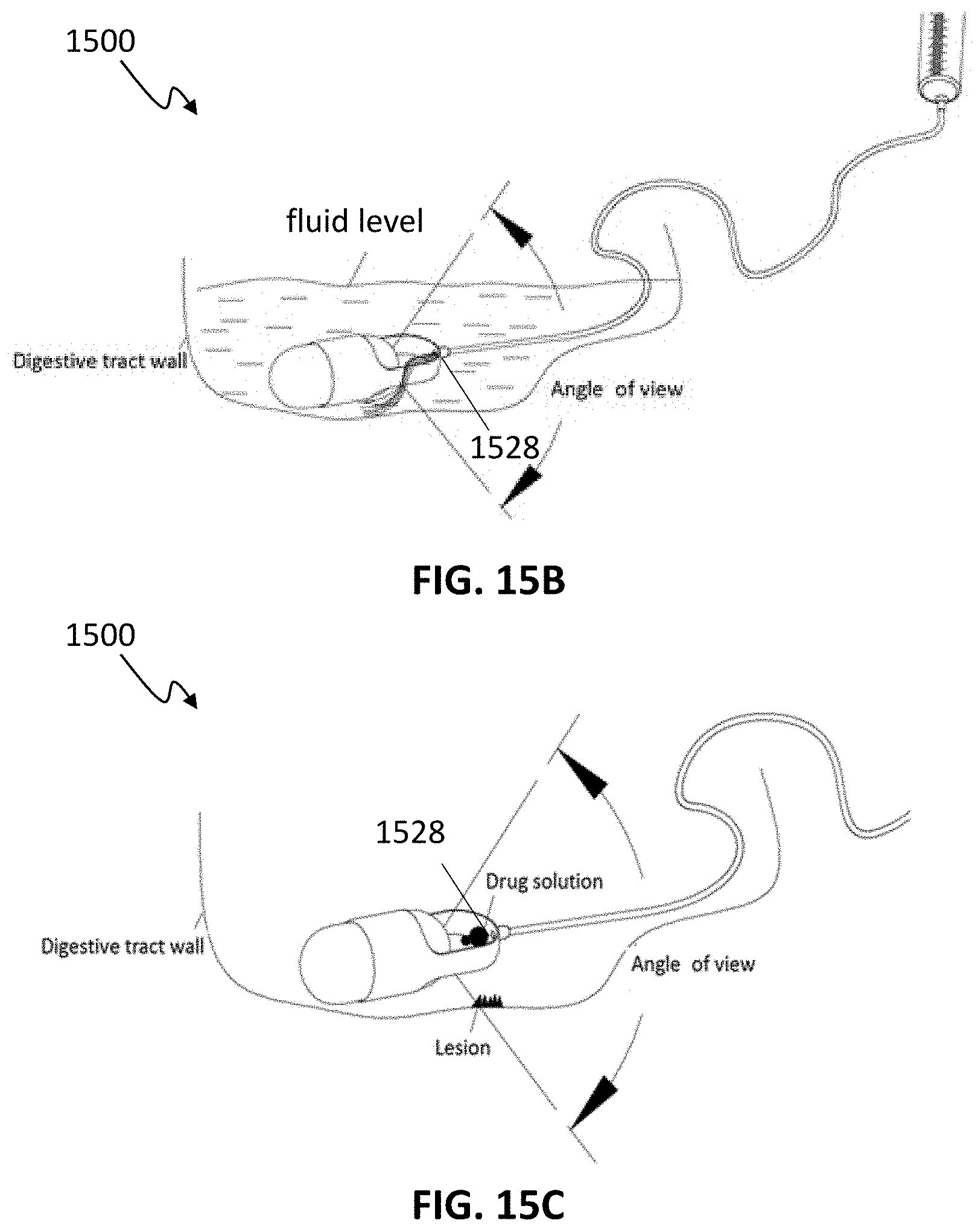 Patent US11771311 Figure 18 – Systems and methods for collecting and screening of pancreatic secretions