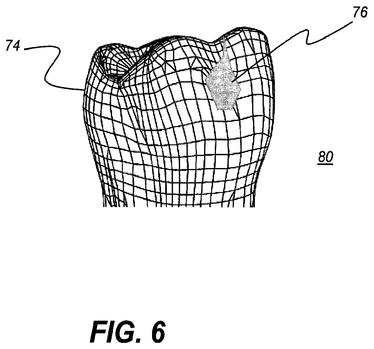 Patent US11771313 Figure 8 – Intra-oral 3-D fluorescence imaging