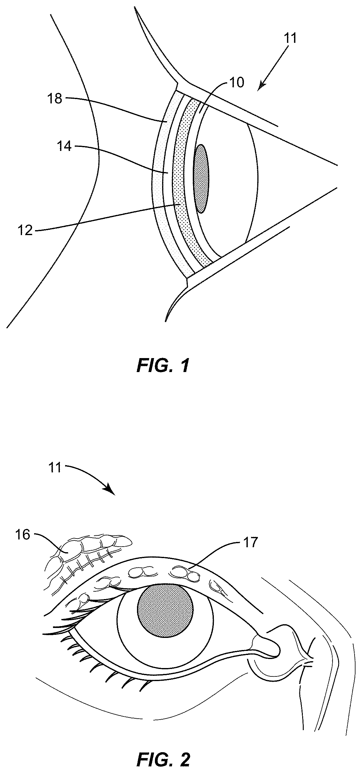 Patent US11771317 Figure 1 – Ocular surface interferometry (OSI) for imaging, processing, and/or displaying an ocular tear film