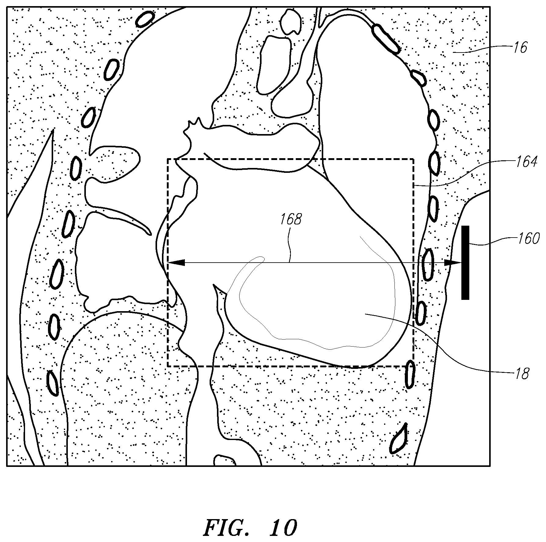 Patent US11771338 Figure 10 – Localized magnetic field generator
