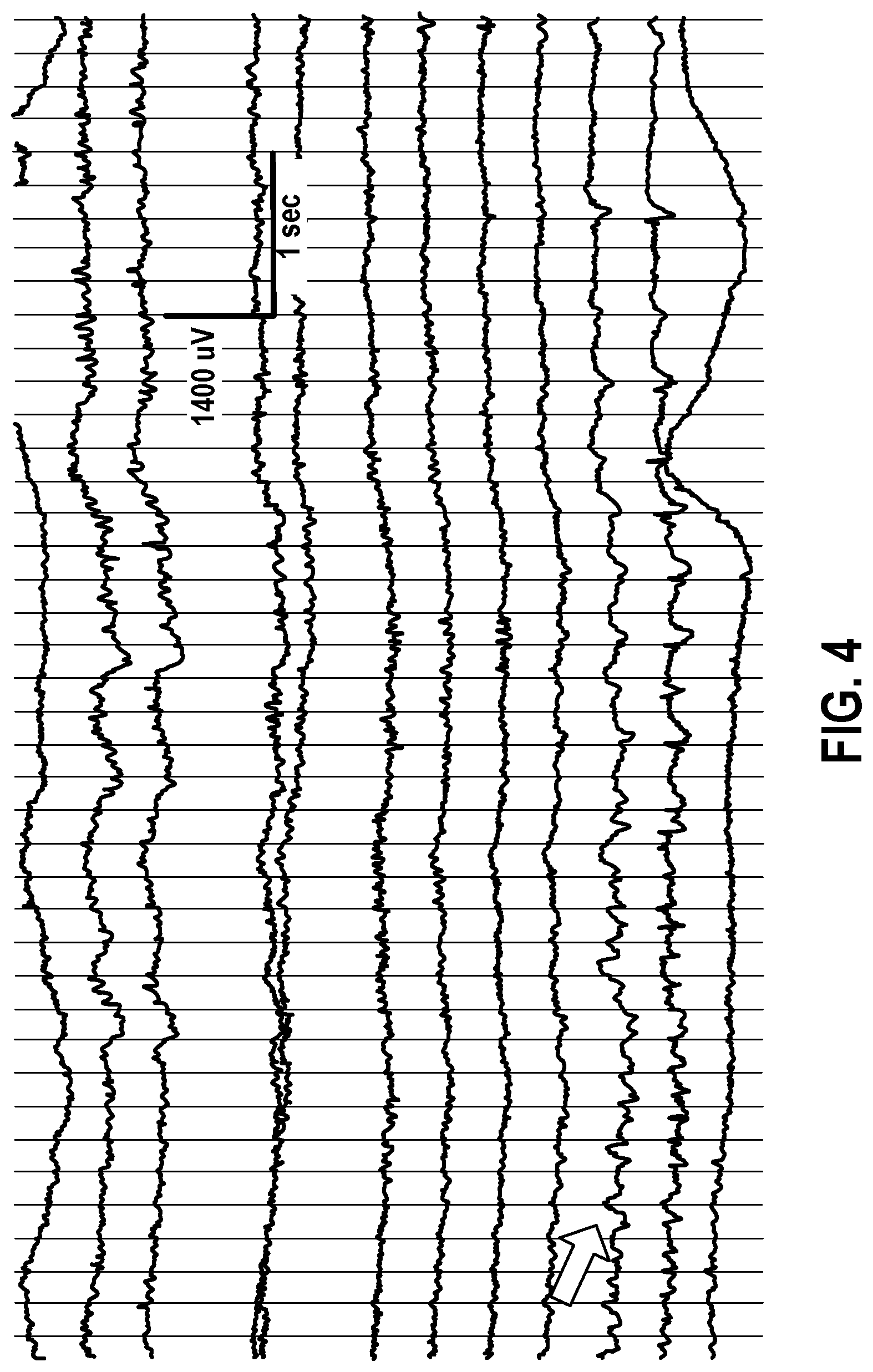 Patent US11771357 Figure 5 – Ring-shaped cortical electrode assembly