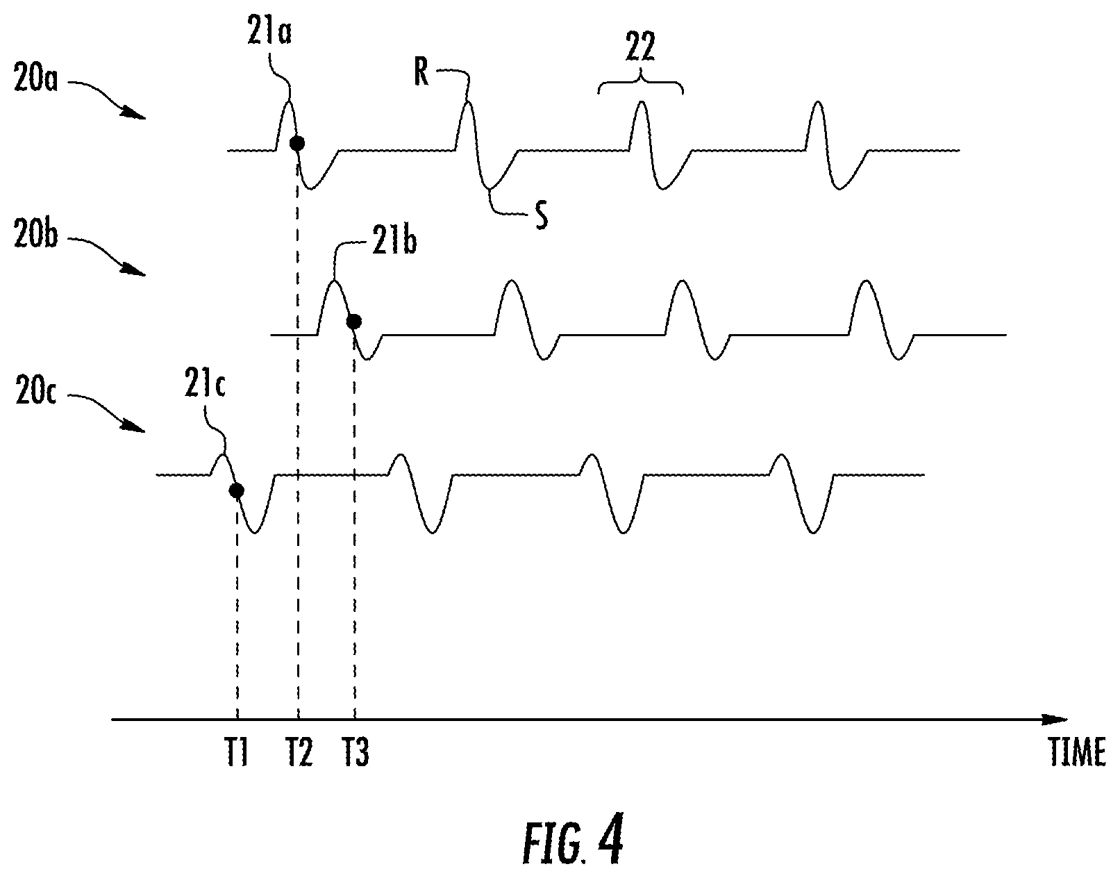 Patent US11771359 Figure 5 – Region of interest focal source detection using comparisons of R-S wave magnitudes and LATs of RS complexes