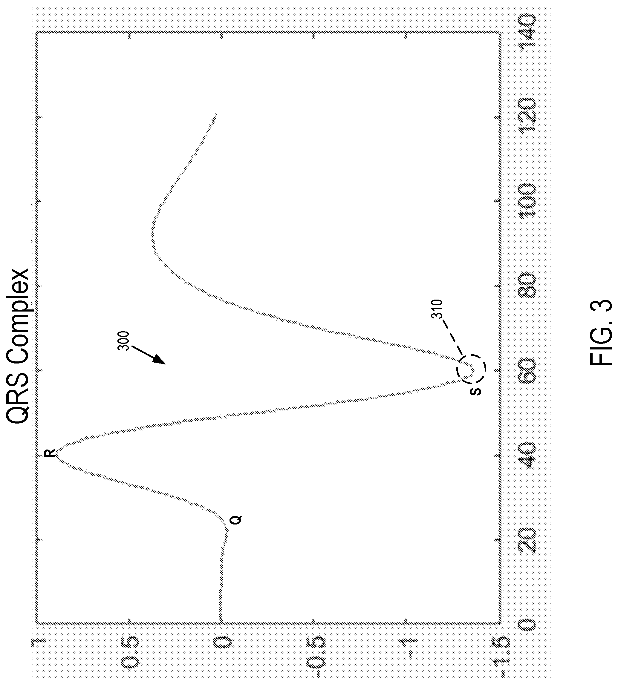 Patent US11771360 Figure 3 – Cardiac monitoring system with normally conducted QRS complex identification