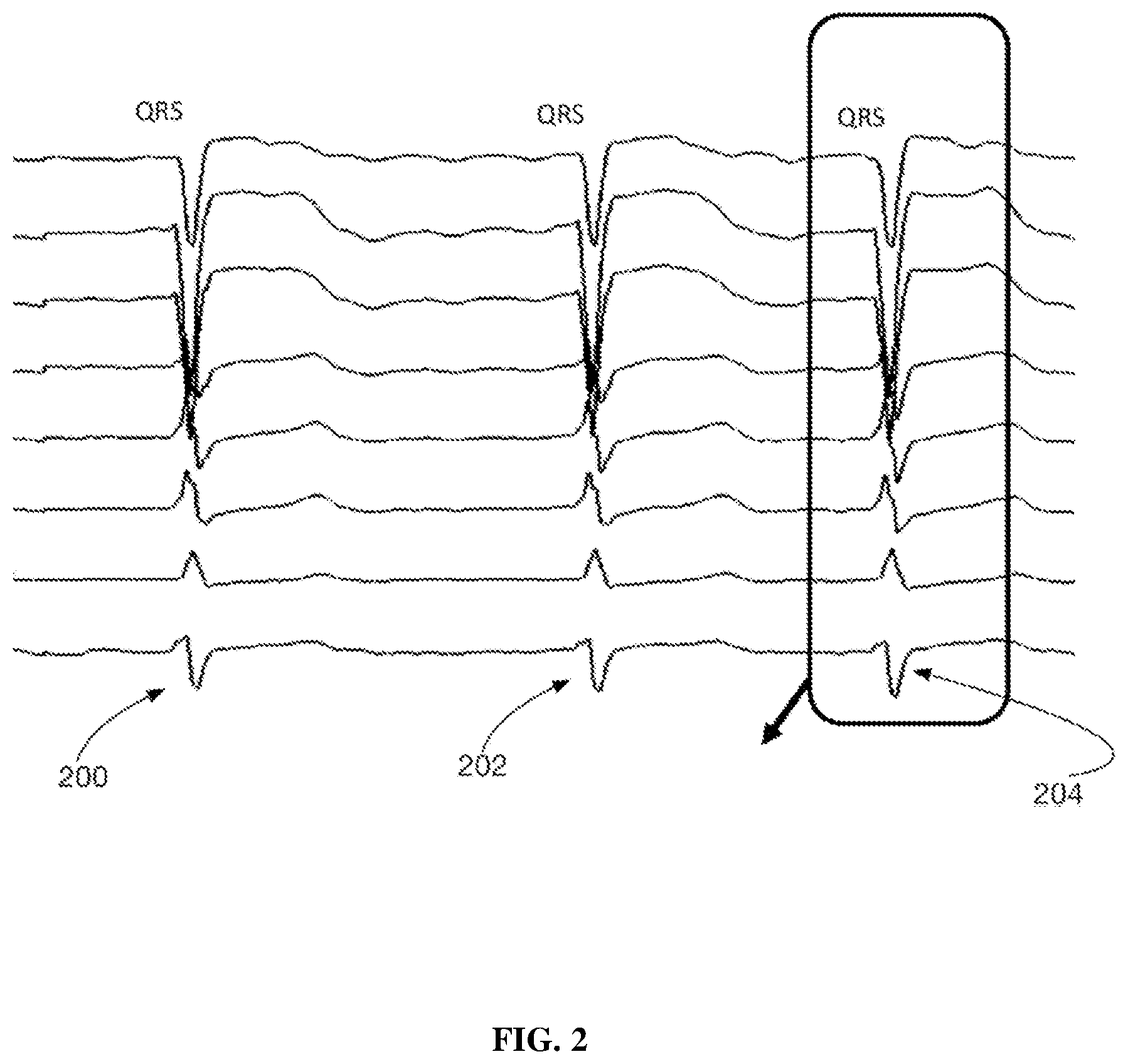 Patent US11771361 Figure 2 – Method and system for determining QRS onset in cardiac signals