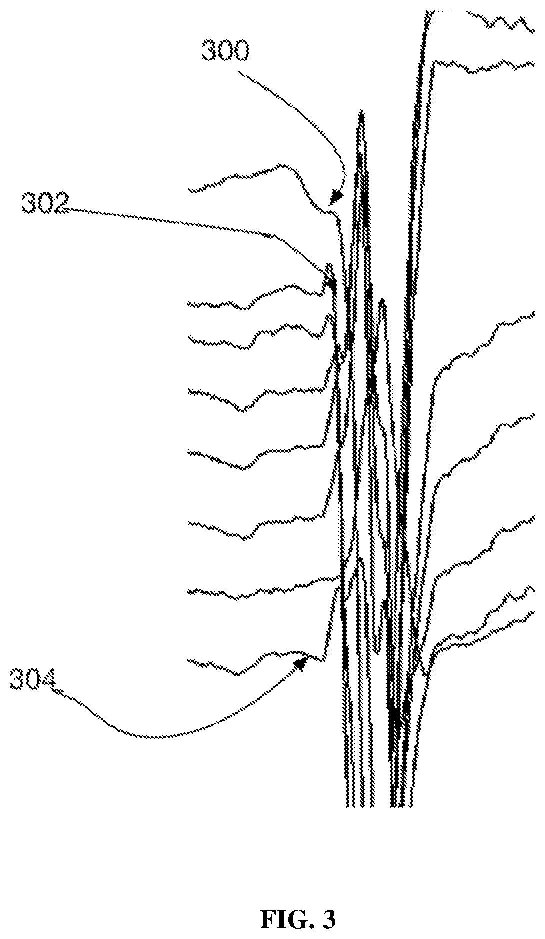Patent US11771361 Figure 3 – Method and system for determining QRS onset in cardiac signals