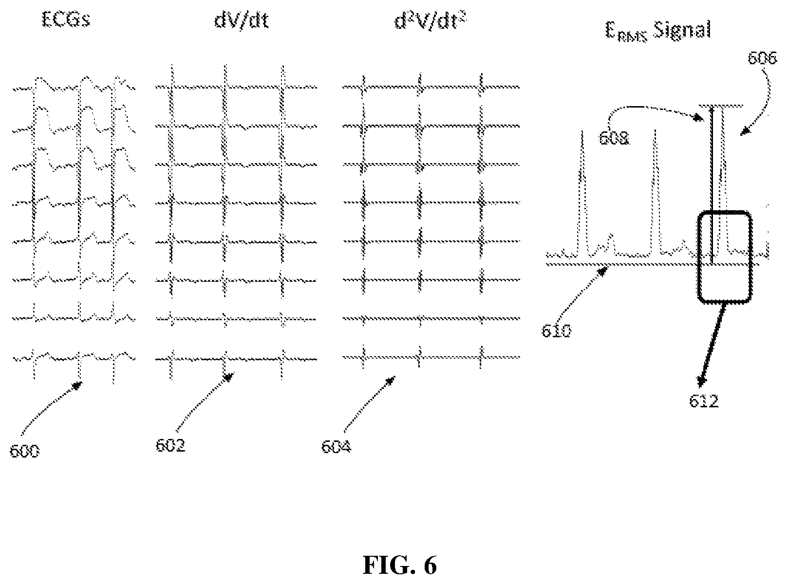 Patent US11771361 Figure 6 – Method and system for determining QRS onset in cardiac signals