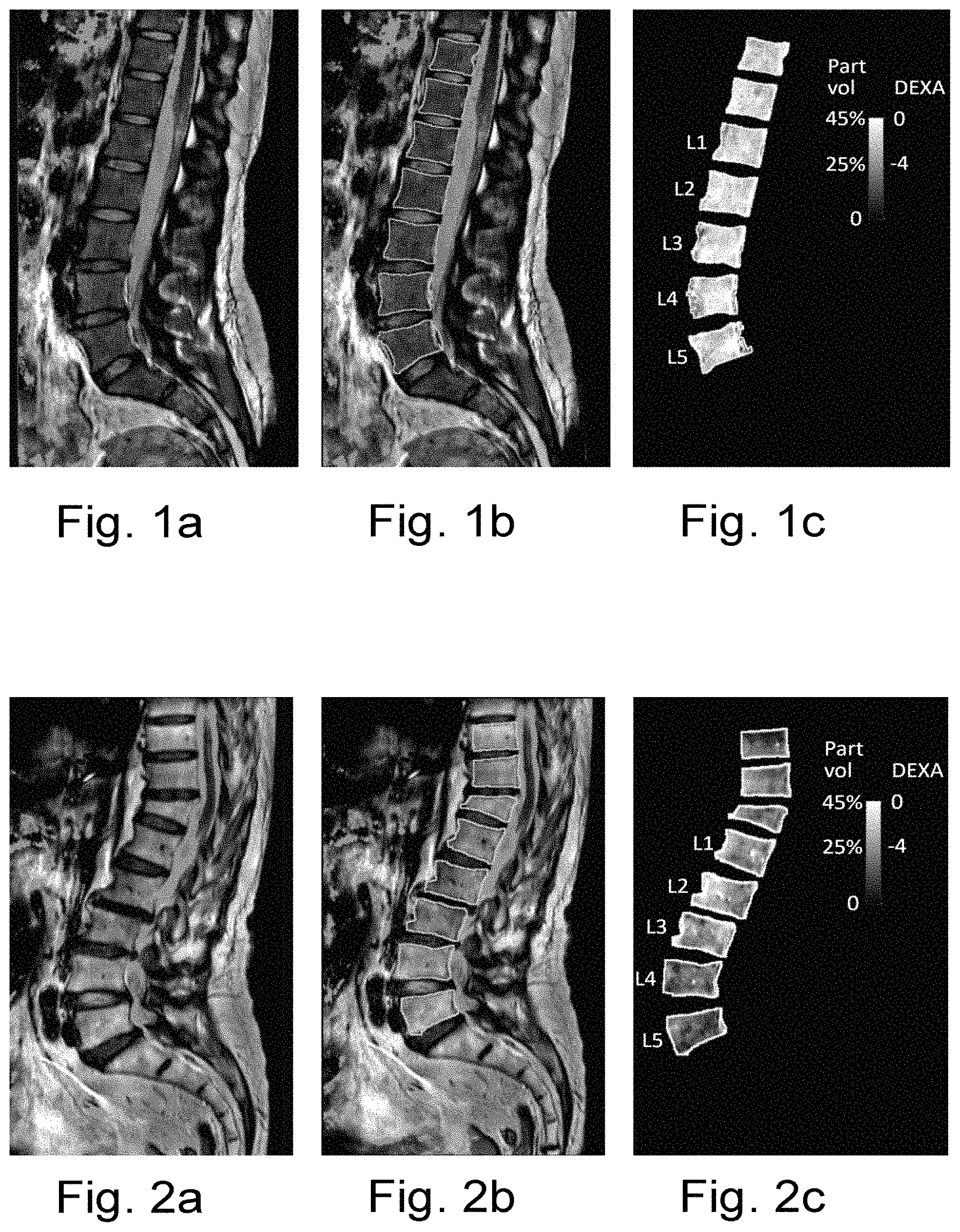 Patent US11771364 Figure 1 – Method and system for estimating bone density