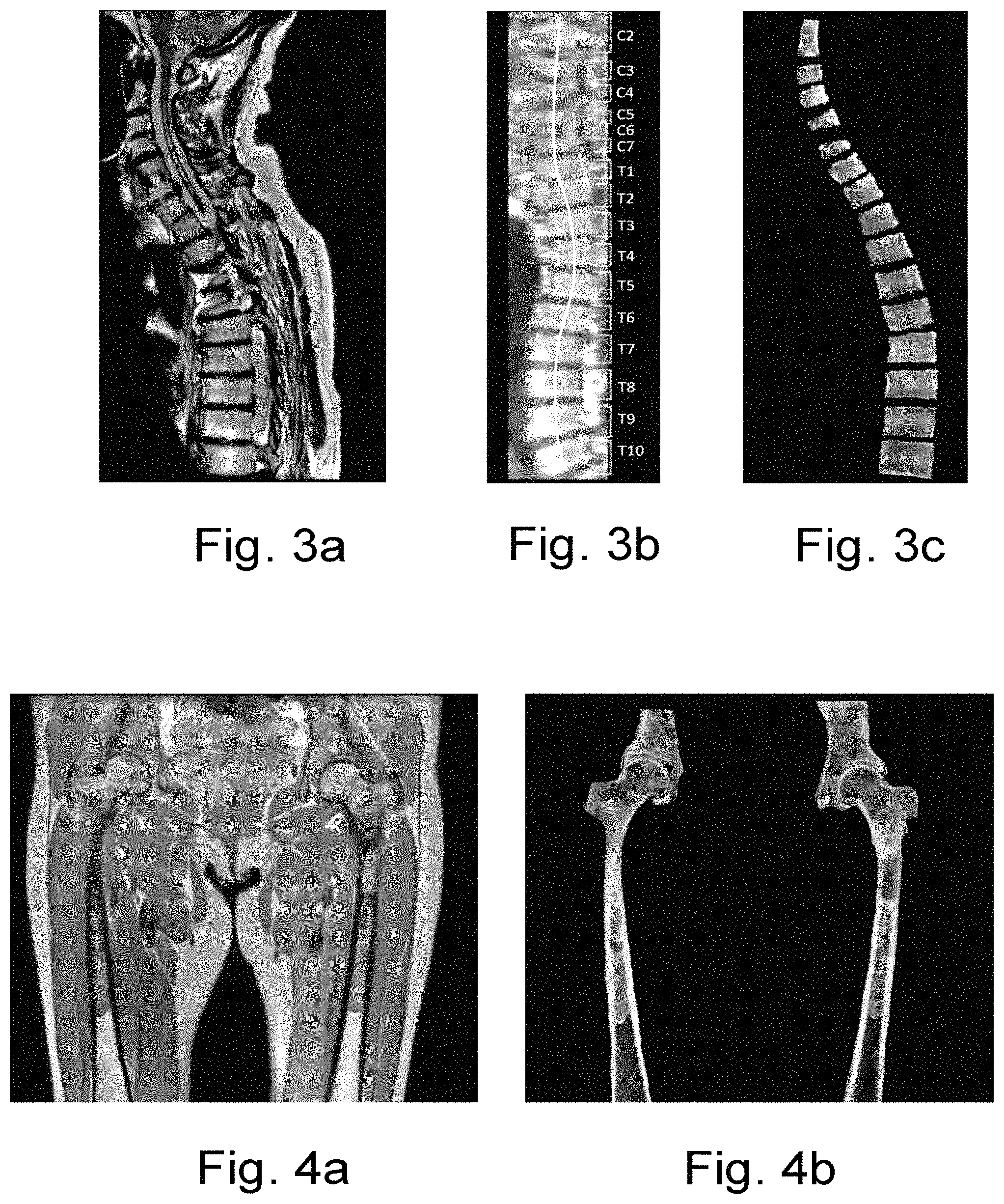 Patent US11771364 Figure 2 – Method and system for estimating bone density