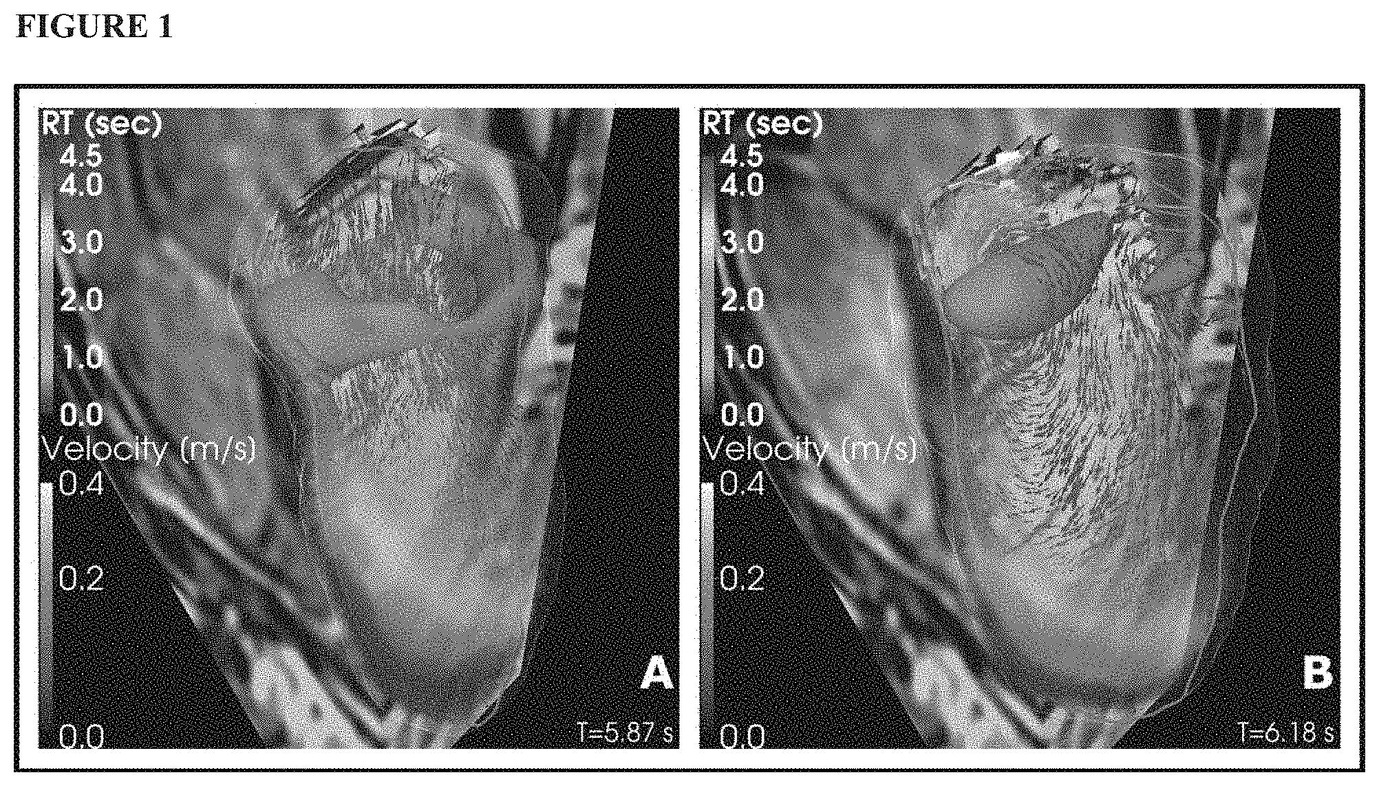 Patent US11771379 Figure 1 – Mapping and quantifying blood stasis and thrombus risk in the heart