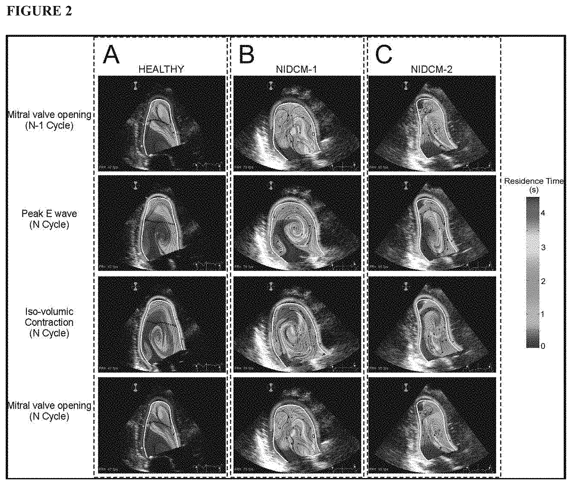 Patent US11771379 Figure 2 – Mapping and quantifying blood stasis and thrombus risk in the heart