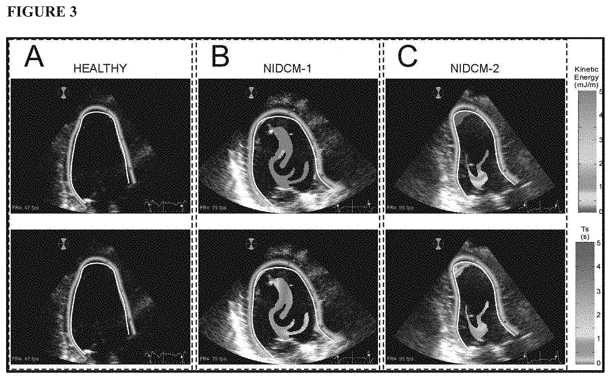 Patent US11771379 Figure 3 – Mapping and quantifying blood stasis and thrombus risk in the heart