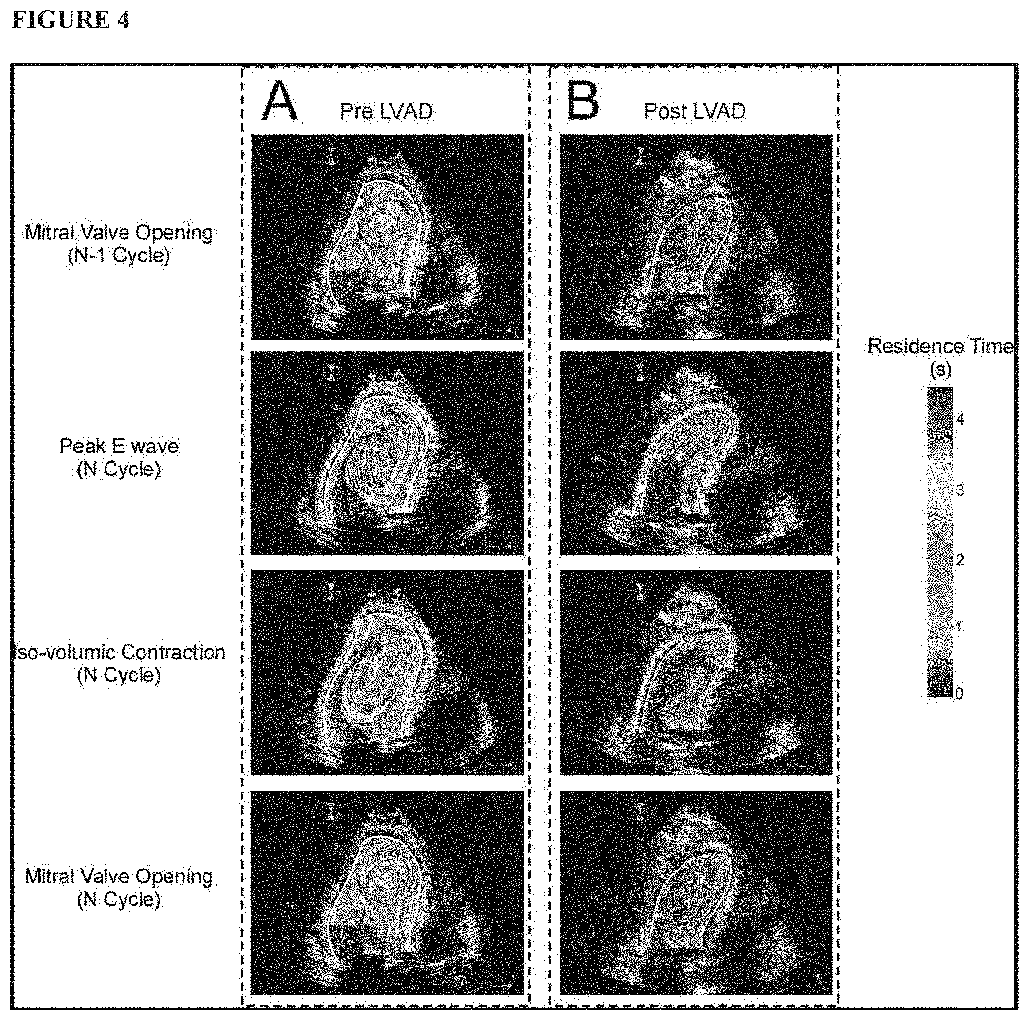 Patent US11771379 Figure 4 – Mapping and quantifying blood stasis and thrombus risk in the heart