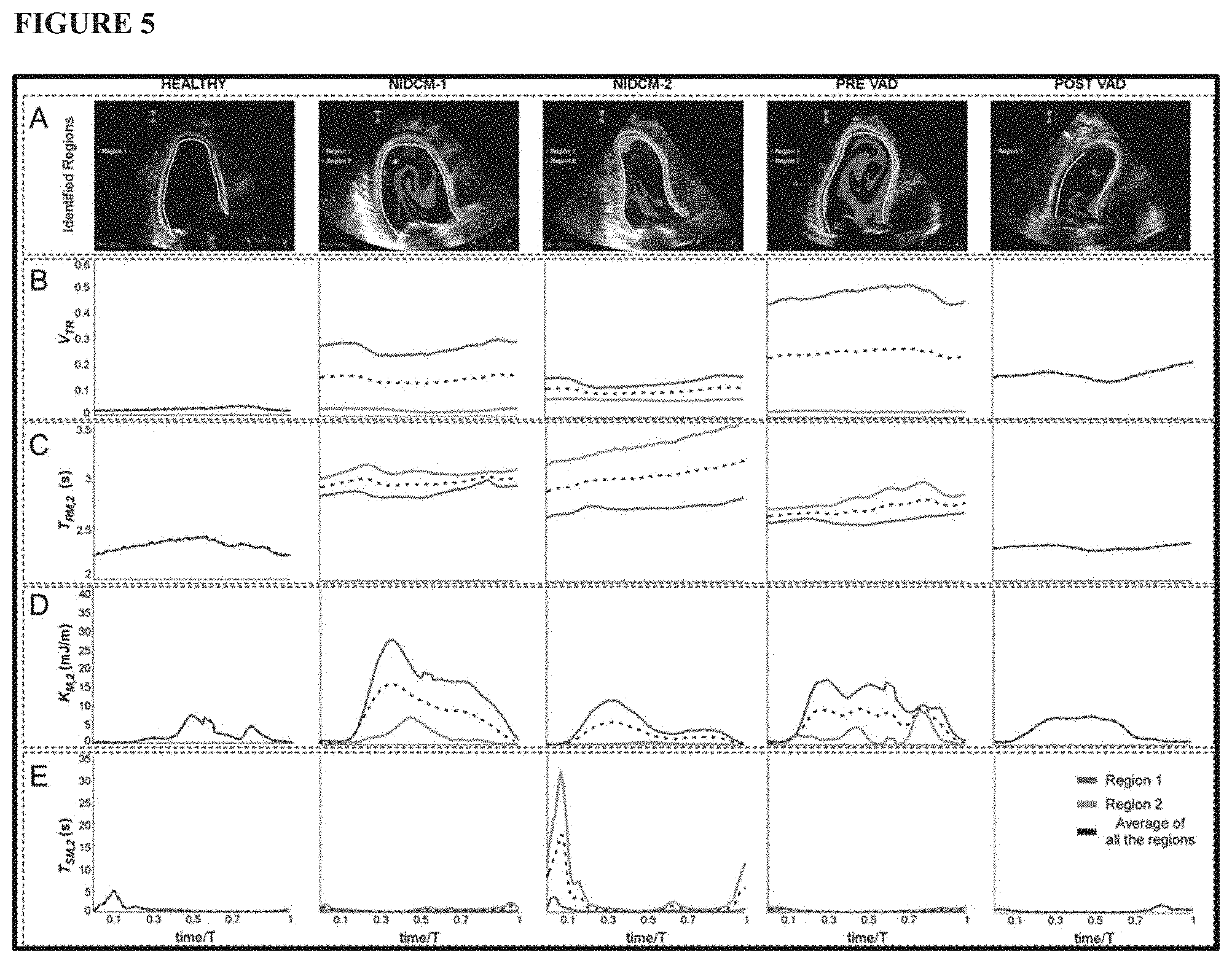 Patent US11771379 Figure 5 – Mapping and quantifying blood stasis and thrombus risk in the heart