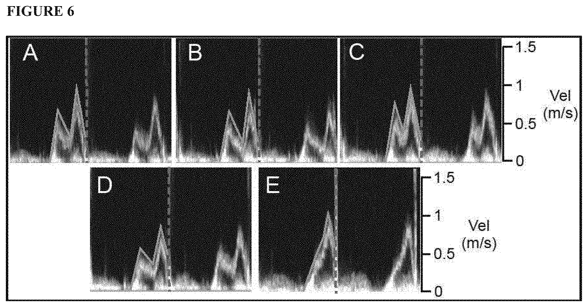 Patent US11771379 Figure 6 – Mapping and quantifying blood stasis and thrombus risk in the heart