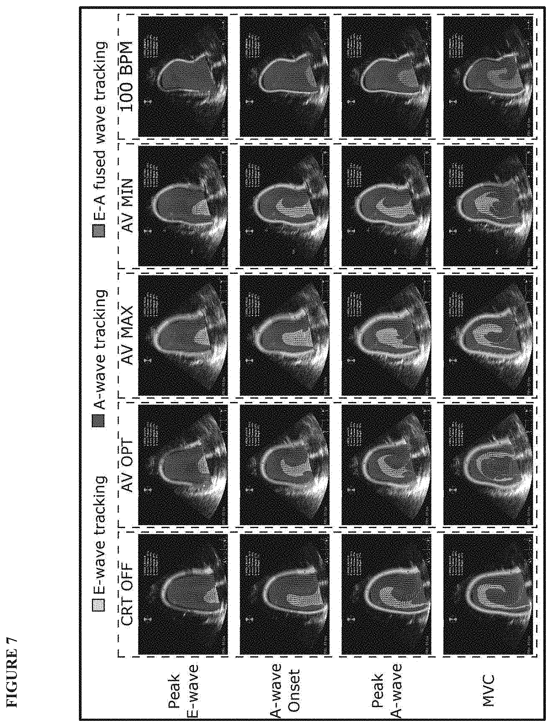 Patent US11771379 Figure 7 – Mapping and quantifying blood stasis and thrombus risk in the heart