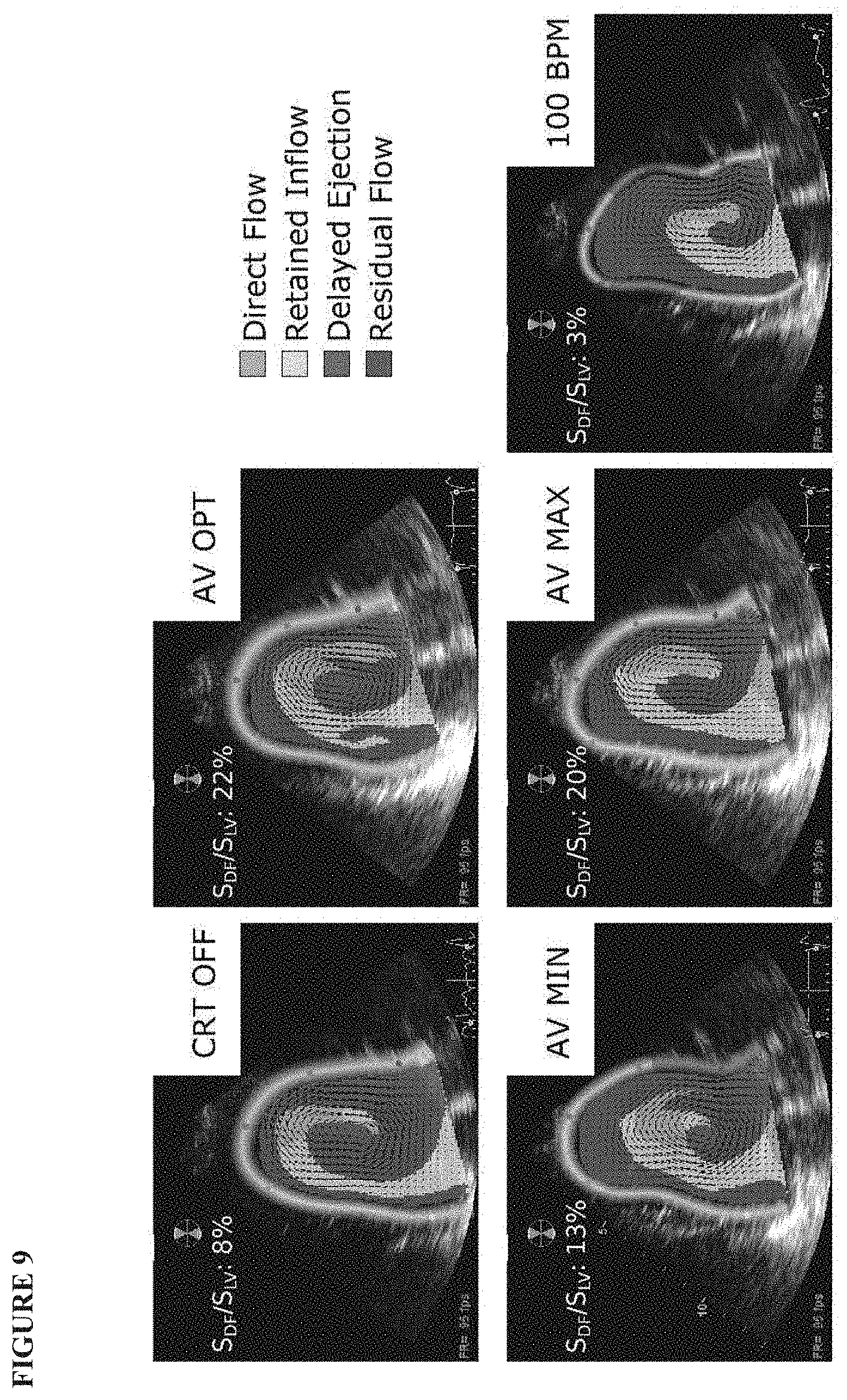 Patent US11771379 Figure 9 – Mapping and quantifying blood stasis and thrombus risk in the heart