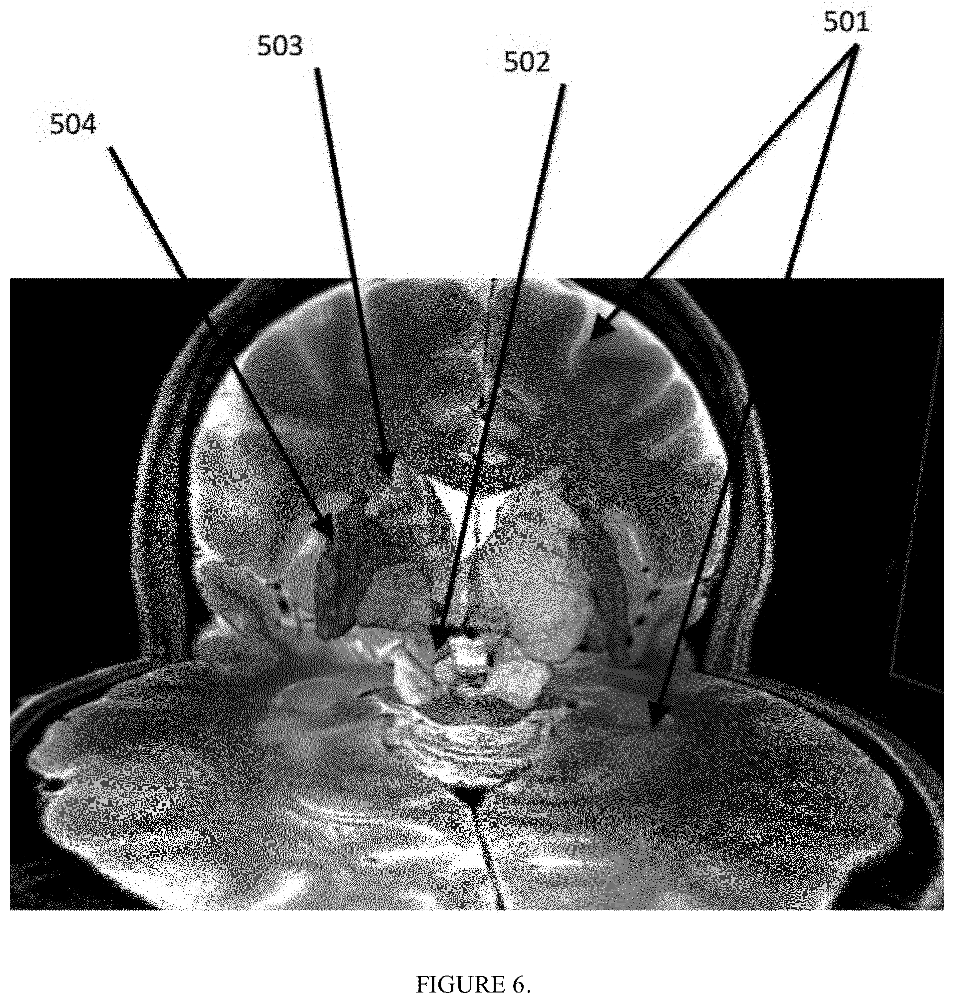 Patent US11771389 Figure 6 – Method for a brain region location and shape prediction