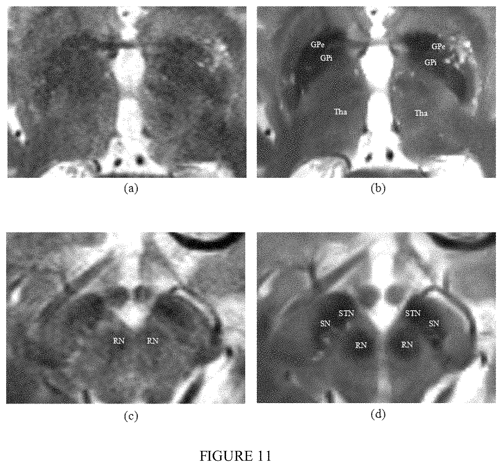 Patent US11771389 Figure 11 – Method for a brain region location and shape prediction
