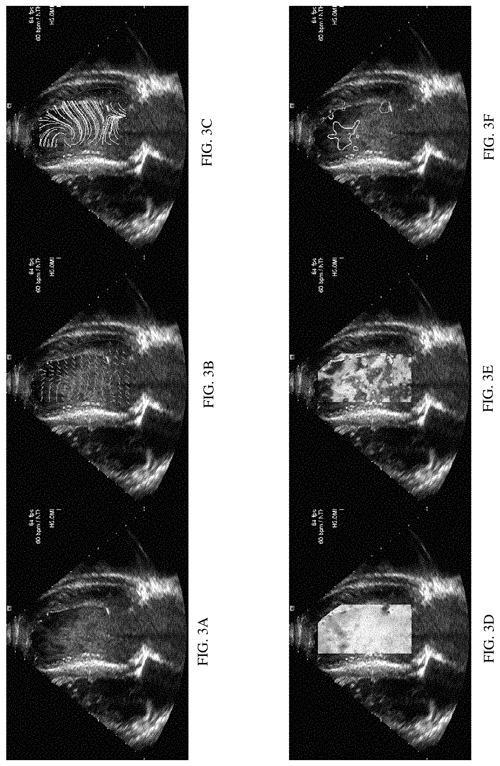 Patent US11771396 Figure 2 – Quantification of blood flow with ultrasound B-mode imaging