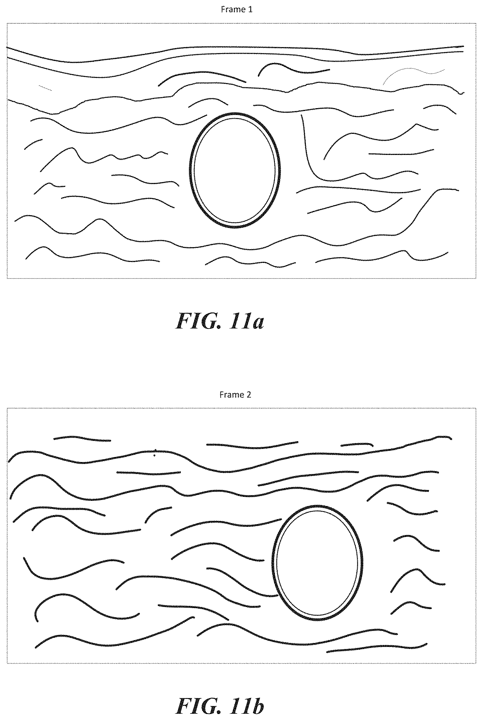 Patent US11771399 Figure 11 – Apparatus and method to guide ultrasound acquisition of the peripheral arteries in the transverse plane
