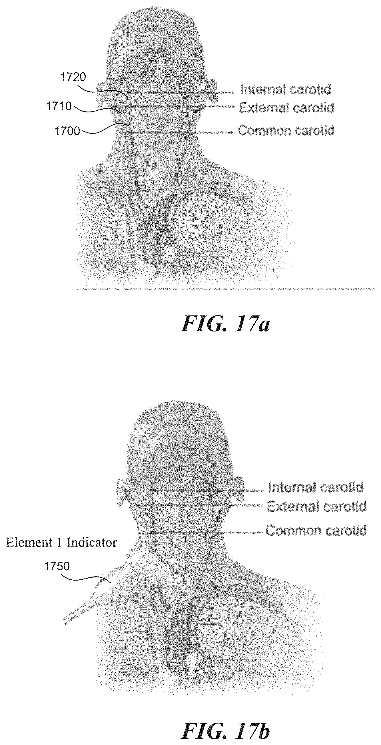 Patent US11771399 Figure 17 – Apparatus and method to guide ultrasound acquisition of the peripheral arteries in the transverse plane