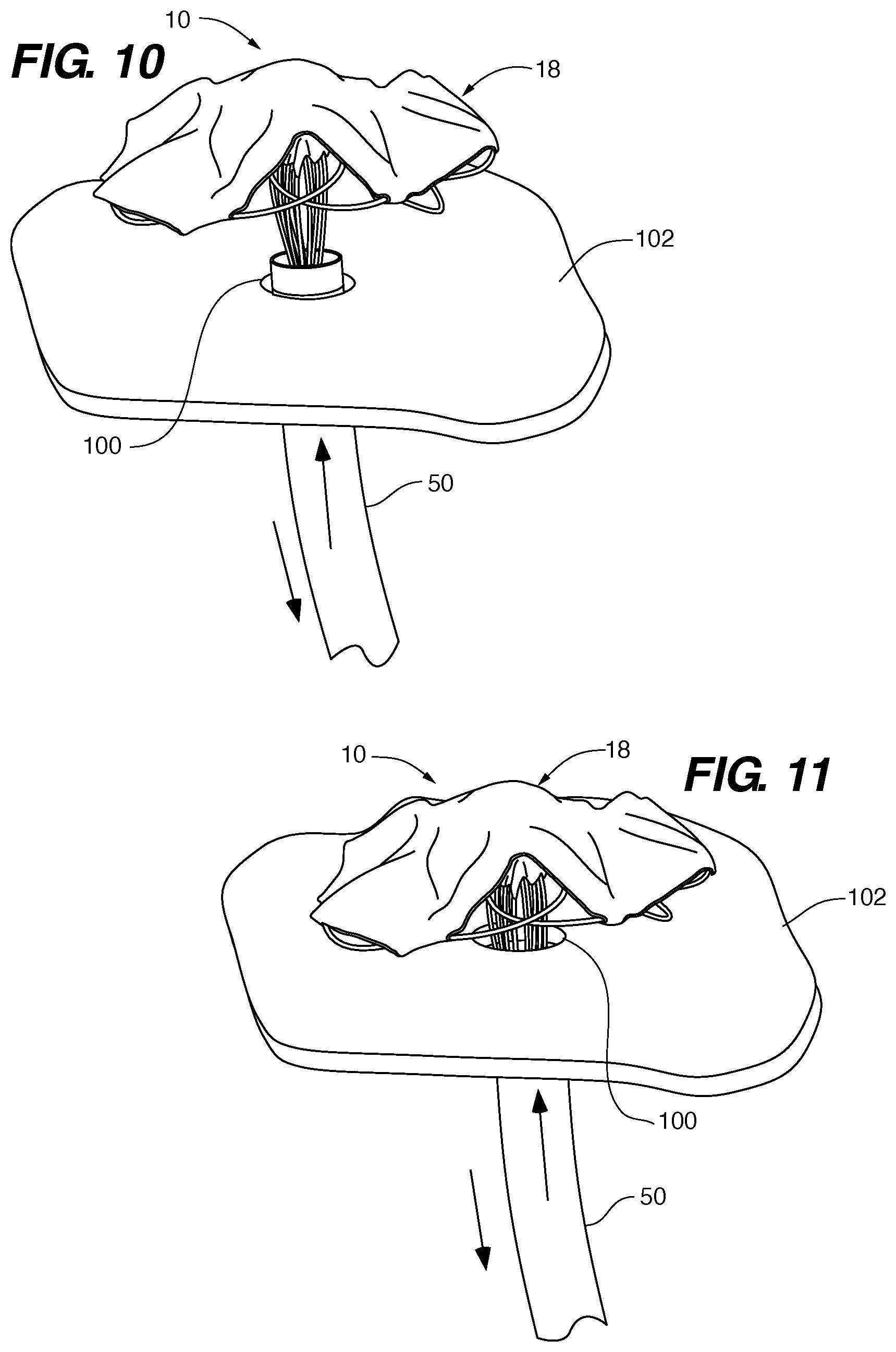 Patent US11771411 Figure 9 – PFO device