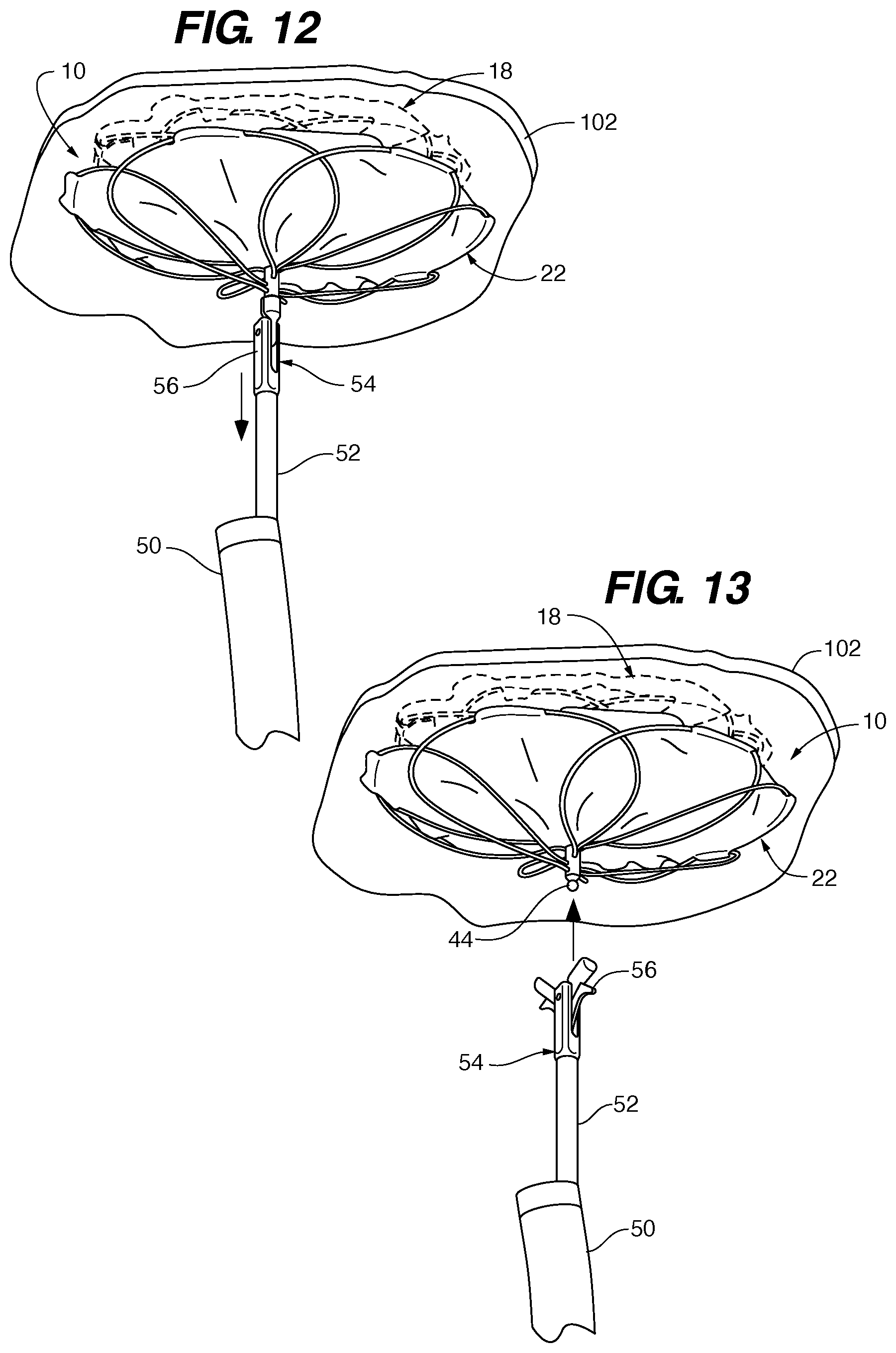 Patent US11771411 Figure 10 – PFO device