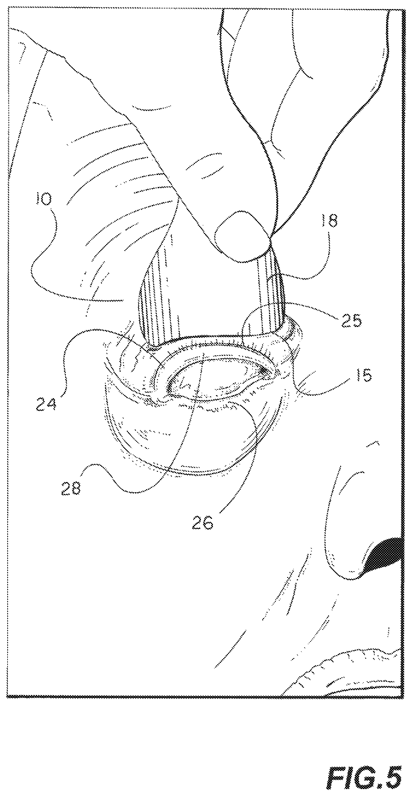 Patent US11771412 Figure 4 – Eyelid flipper tool