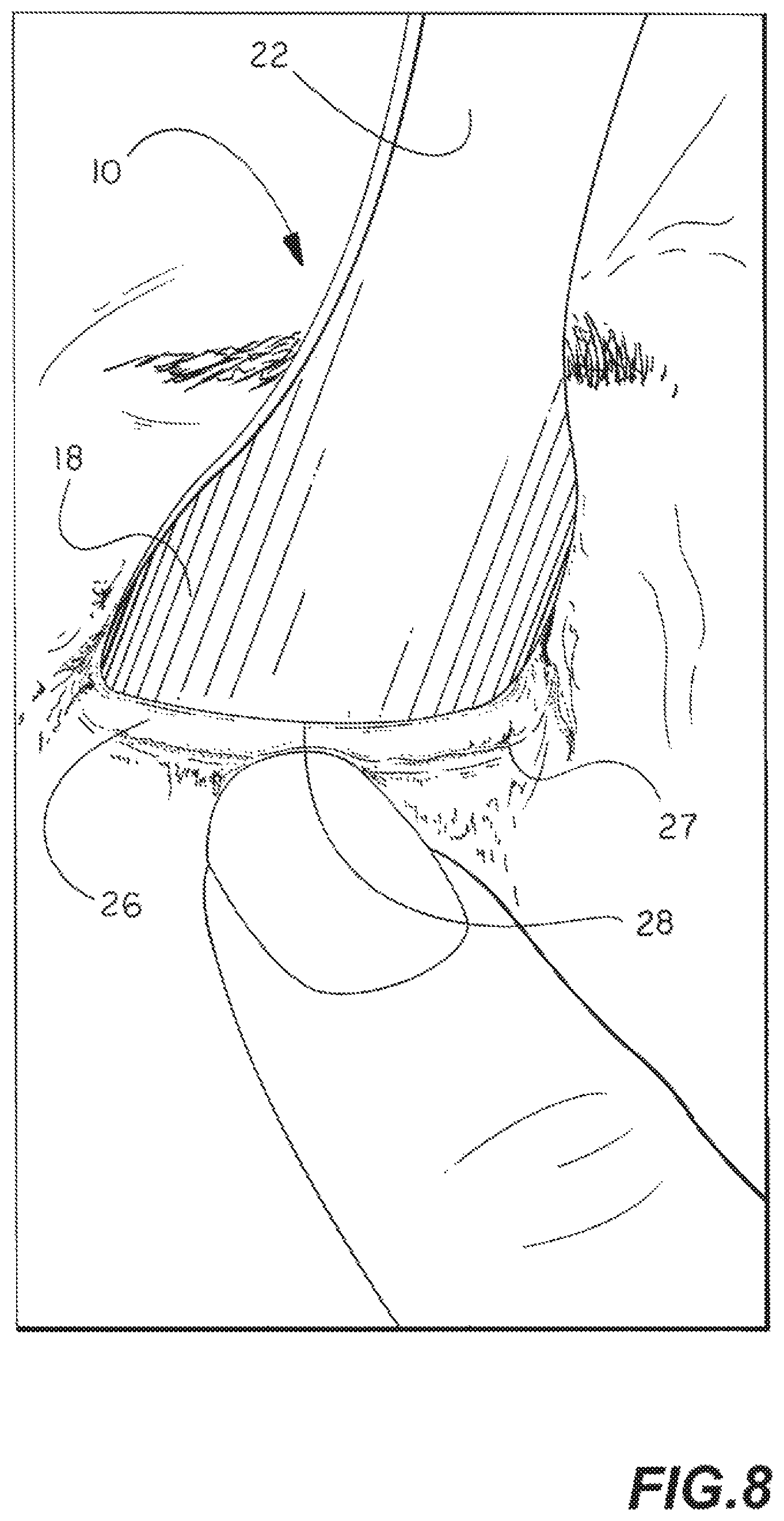 Patent US11771412 Figure 7 – Eyelid flipper tool