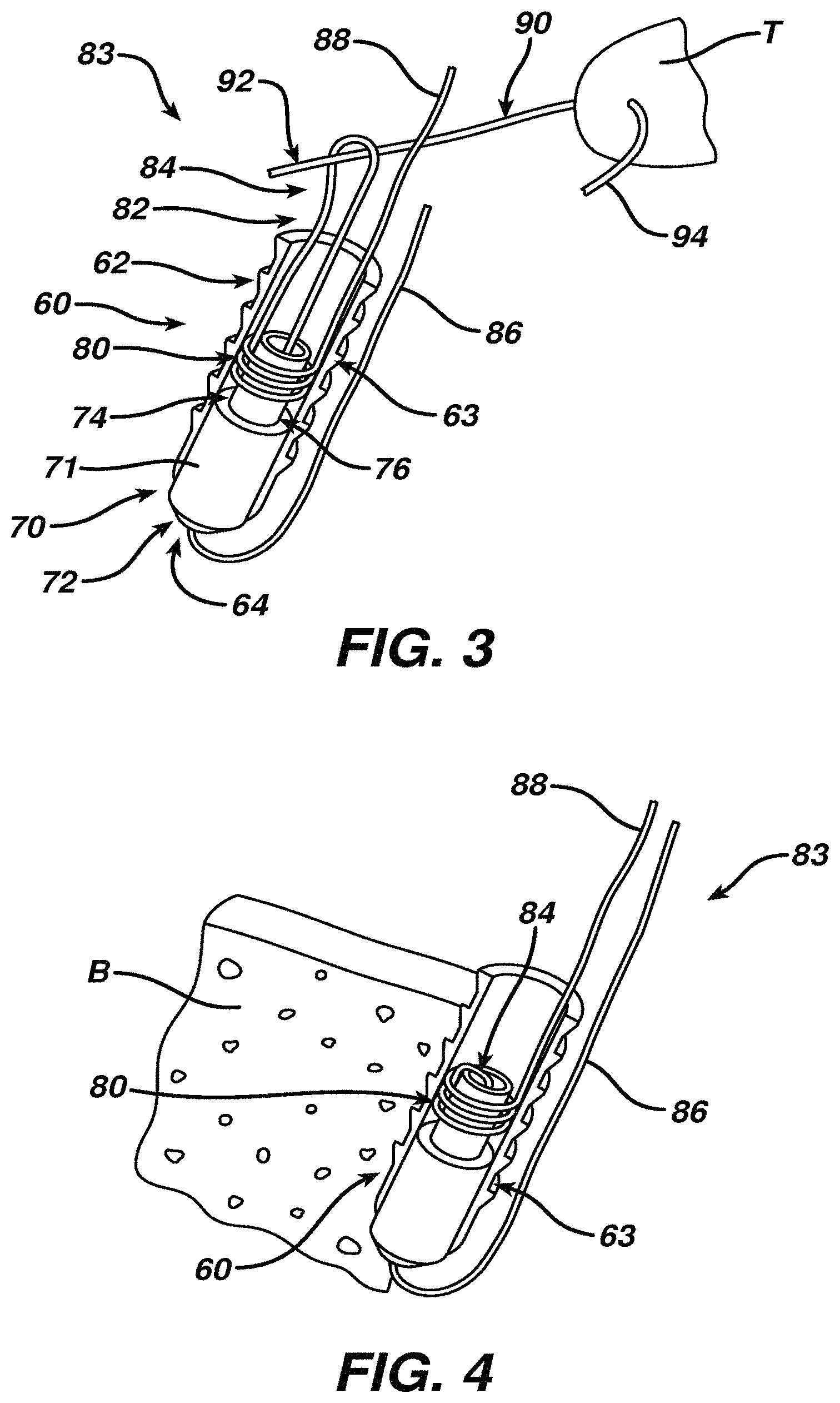 Patent US11771414 Figure 2 – Surgical filament assemblies
