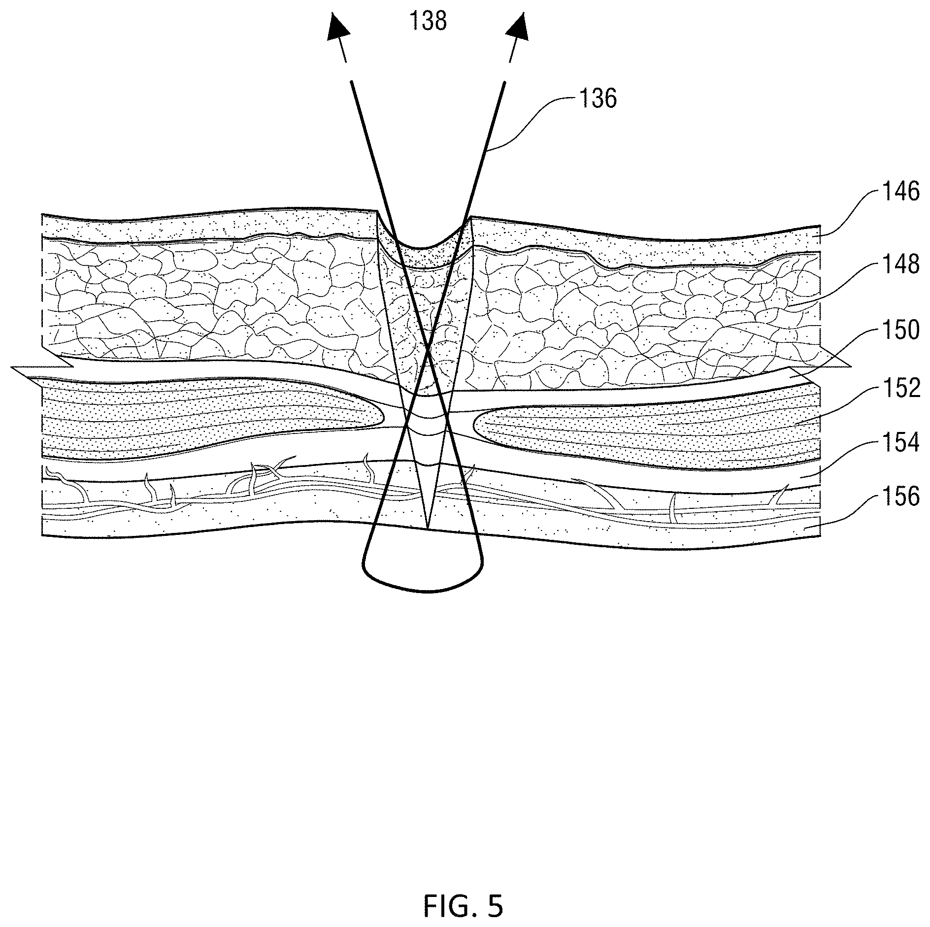 Patent US11771415 Figure 5 – Specialized knot pusher for surgical port closure and suturing devices