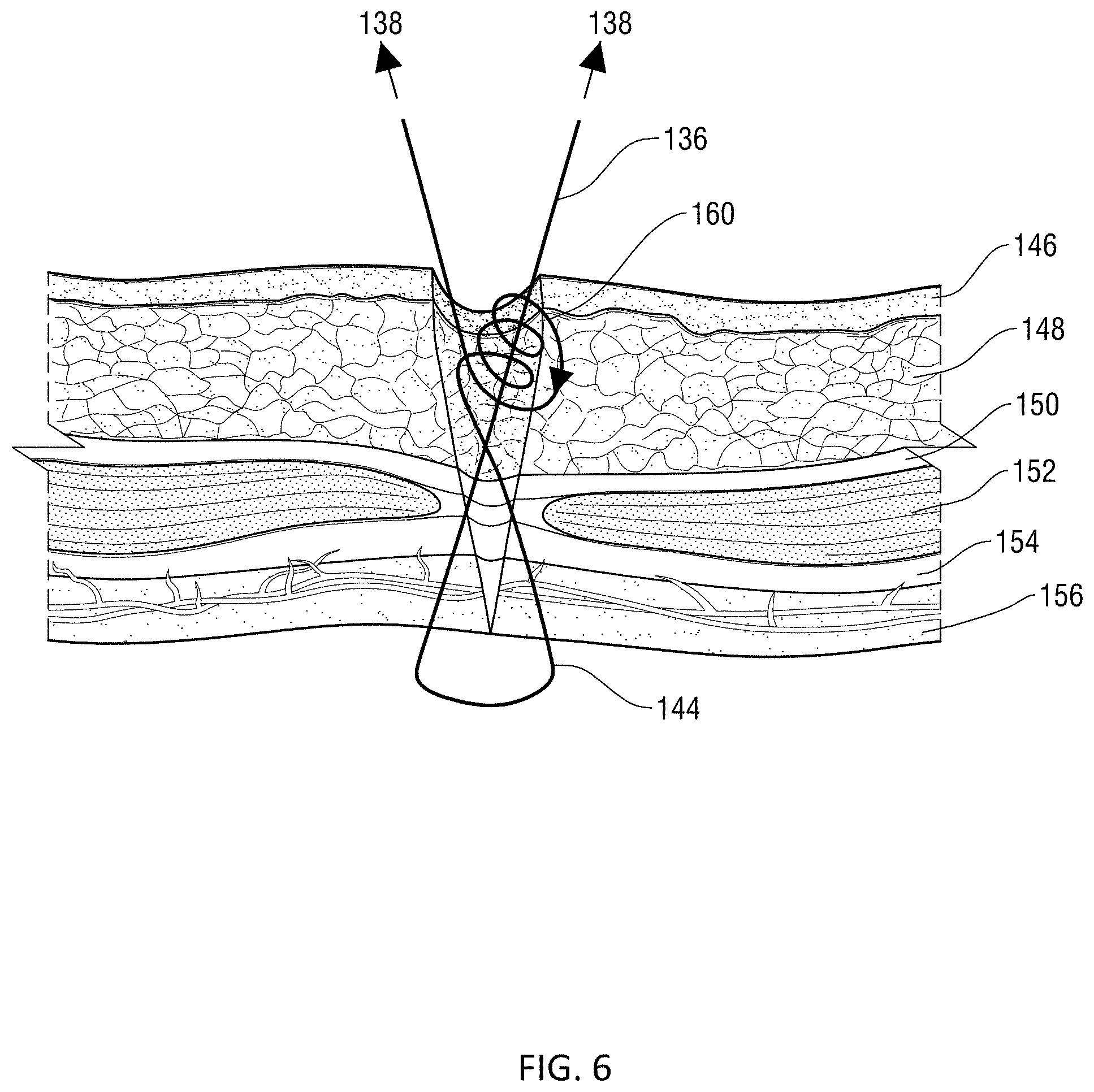 Patent US11771415 Figure 6 – Specialized knot pusher for surgical port closure and suturing devices
