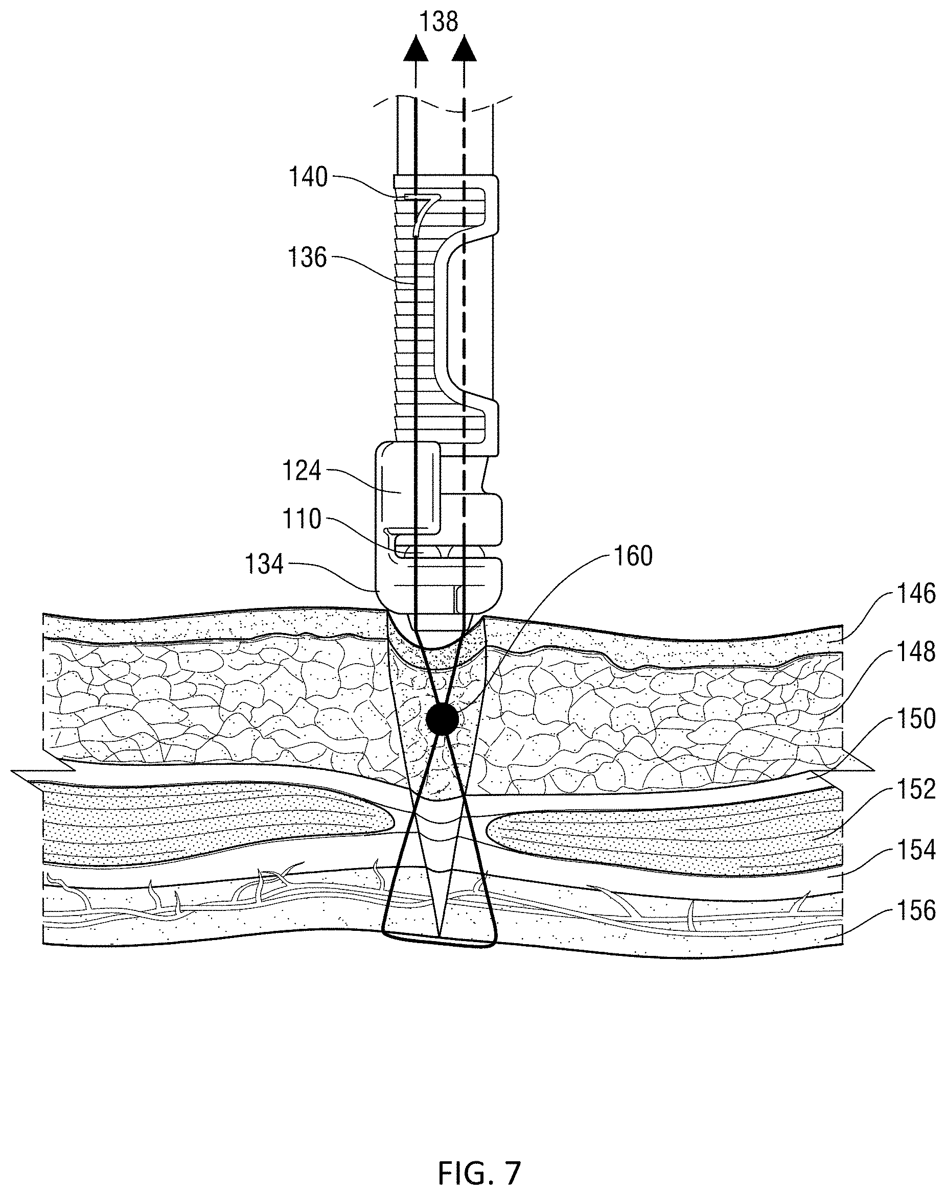 Patent US11771415 Figure 7 – Specialized knot pusher for surgical port closure and suturing devices
