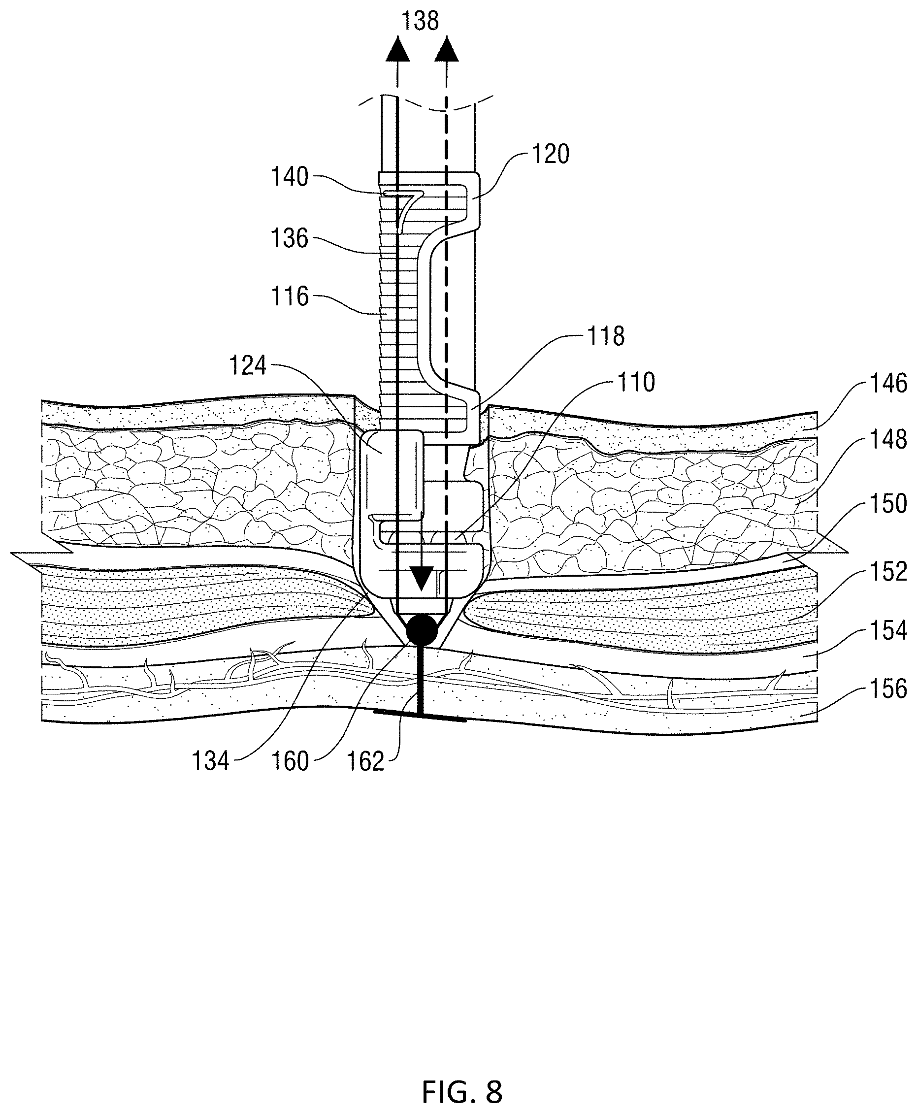 Patent US11771415 Figure 8 – Specialized knot pusher for surgical port closure and suturing devices