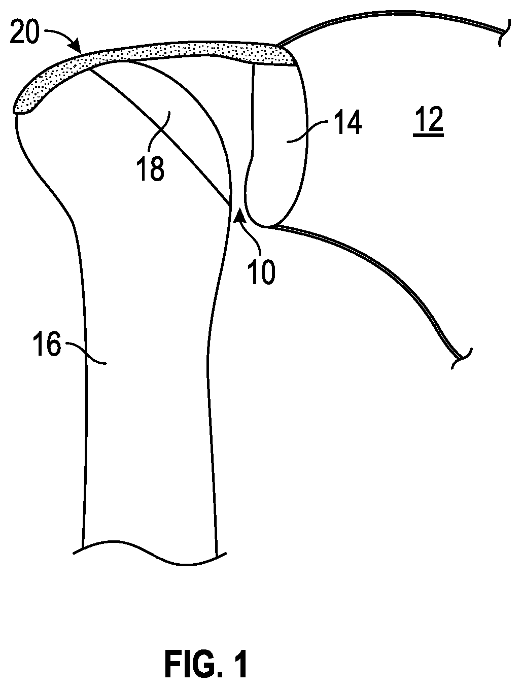 Patent US11771416 — Surgical tools and associated graft augmentation techniques — Figure 1