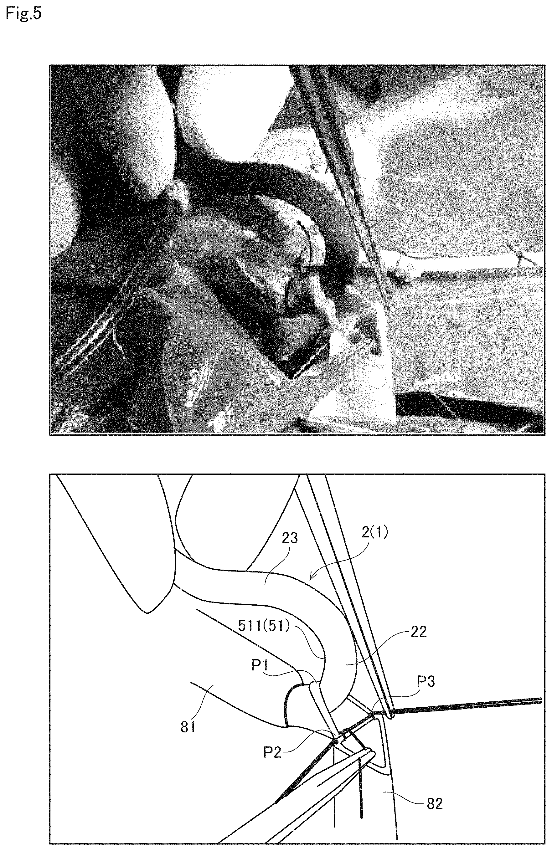 Patent US11771431 Figure 5 – Anastomosis assist tool and vascular anastomosis method