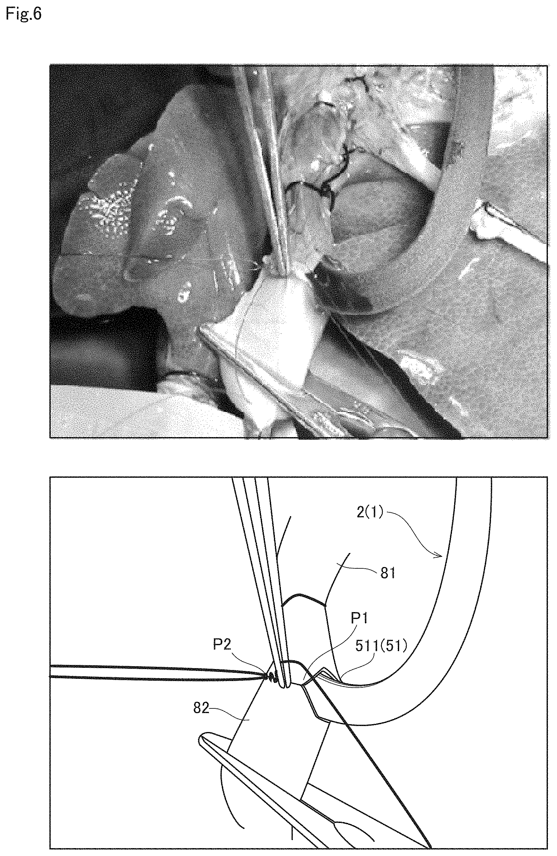 Patent US11771431 Figure 6 – Anastomosis assist tool and vascular anastomosis method