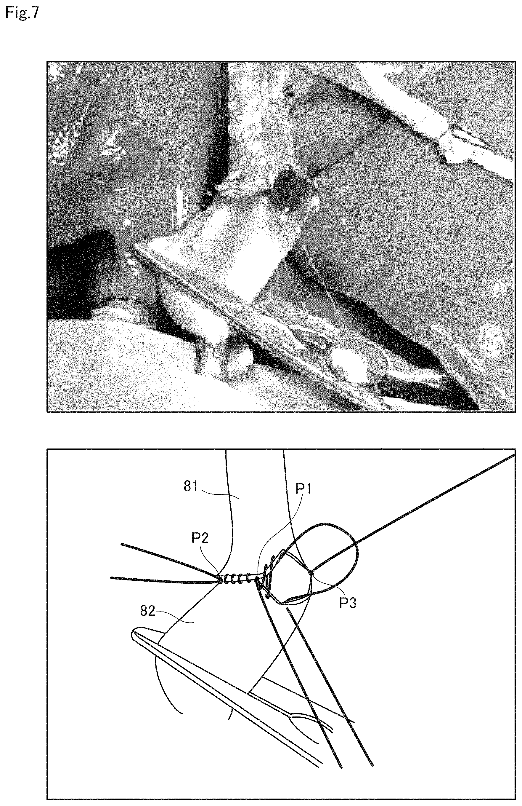 Patent US11771431 Figure 7 – Anastomosis assist tool and vascular anastomosis method