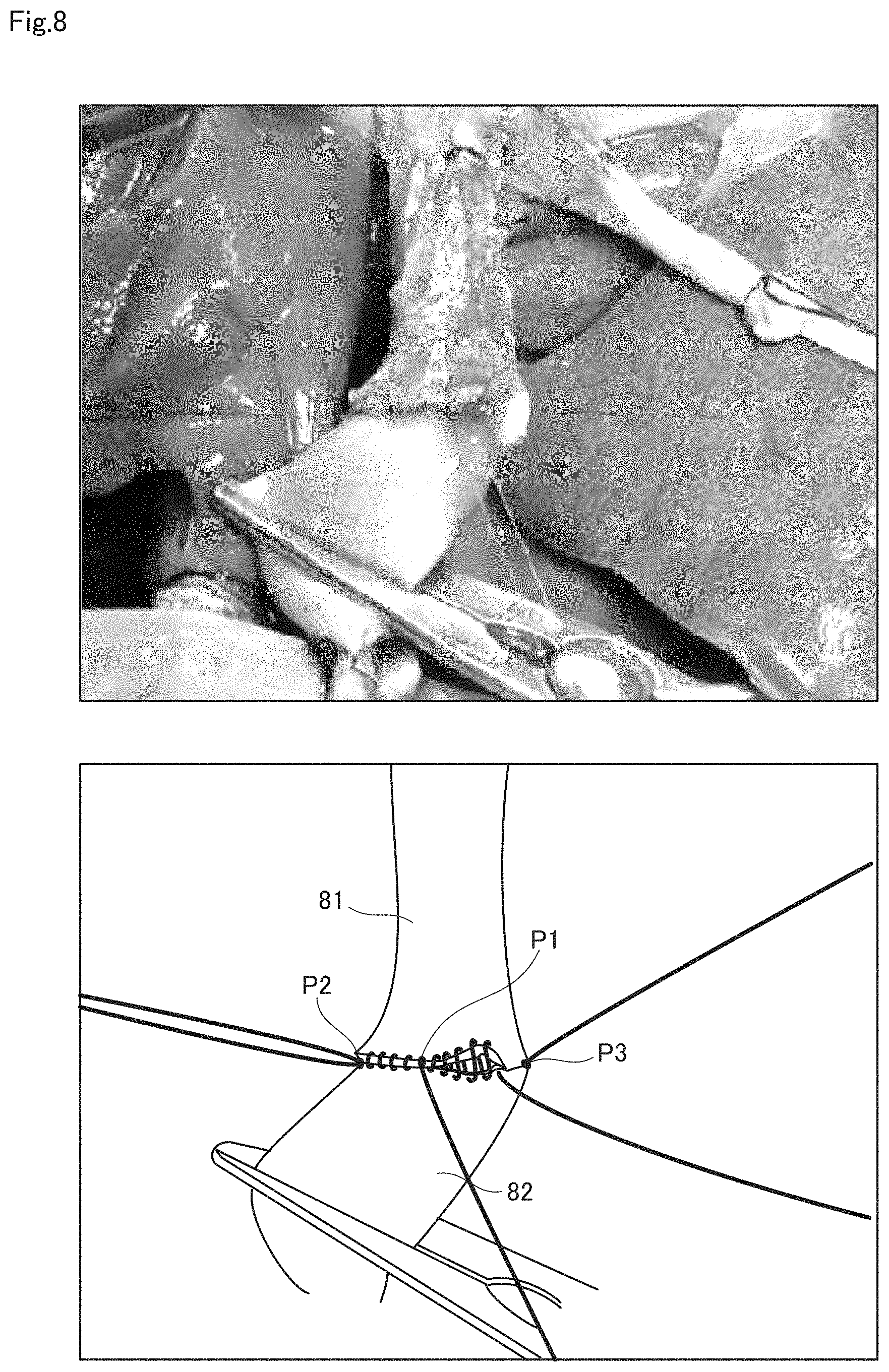 Patent US11771431 Figure 8 – Anastomosis assist tool and vascular anastomosis method