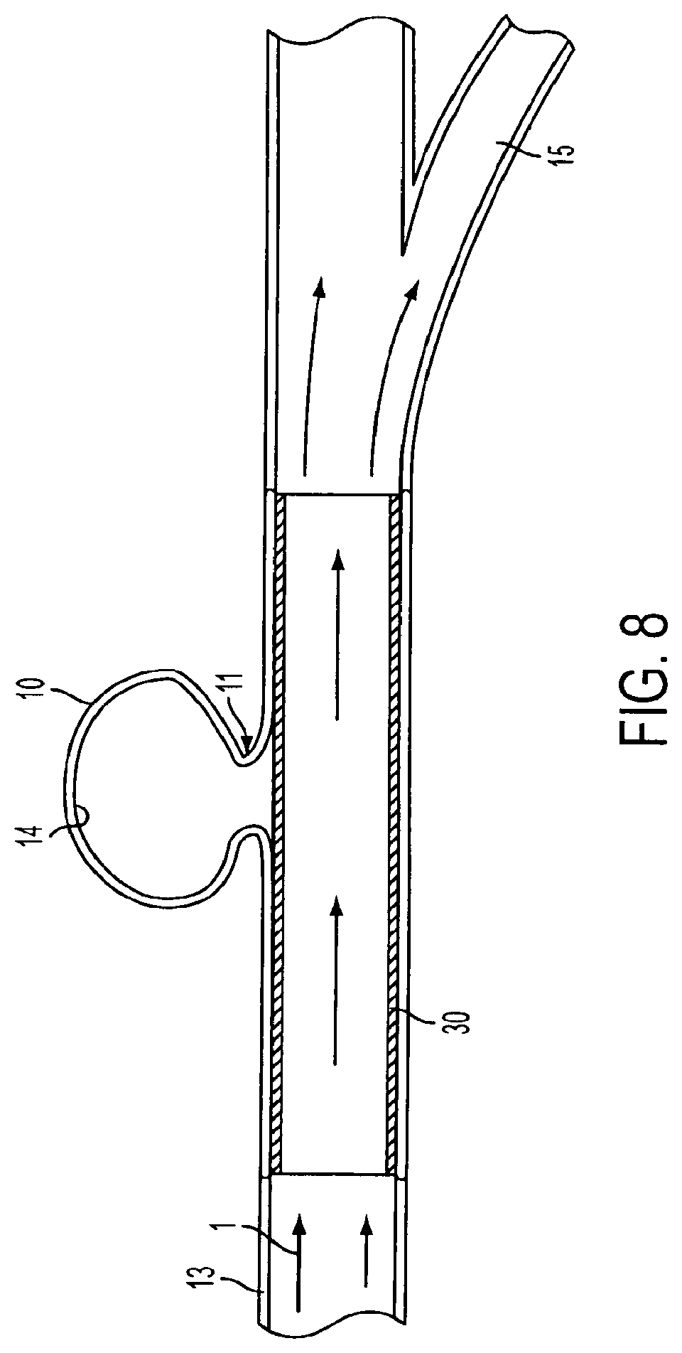 Patent US11771433 Figure 7 – Flexible vascular occluding device