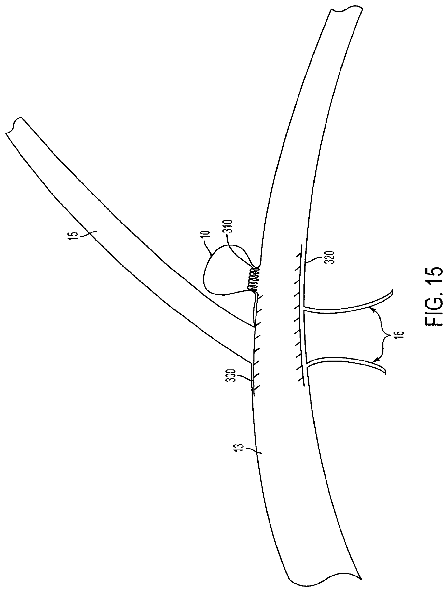 Patent US11771433 Figure 14 – Flexible vascular occluding device