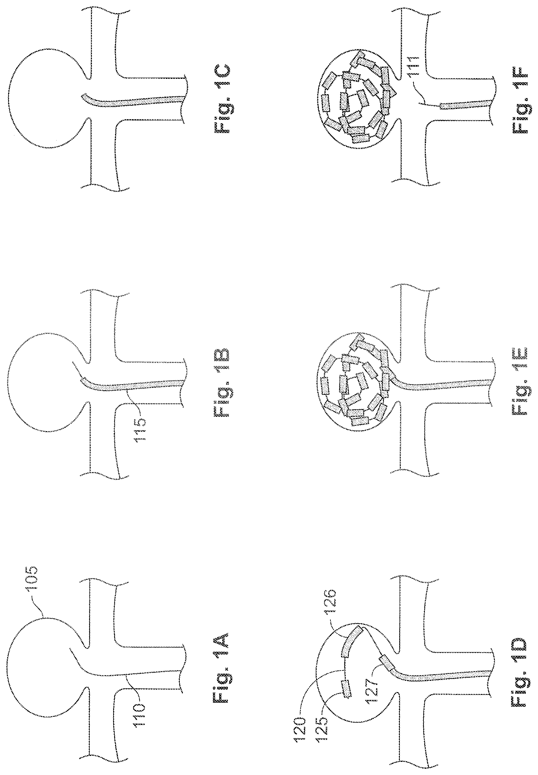 Patent US11771435 Figure 1 – Expandable implant and implant system