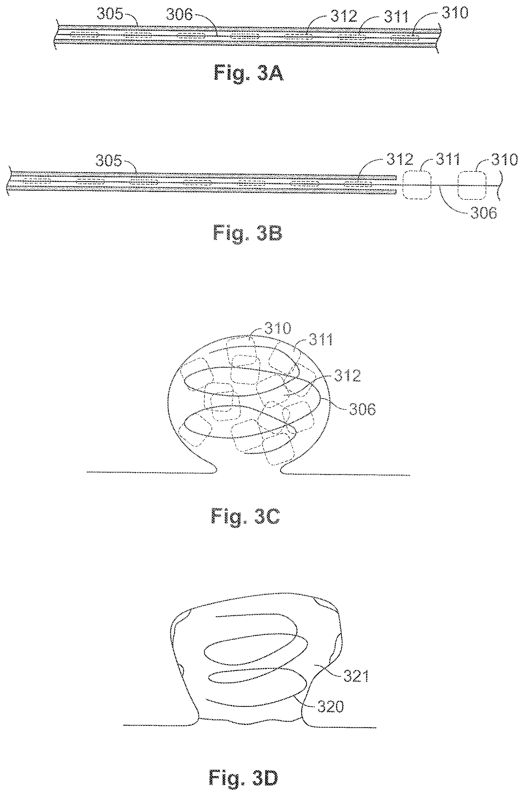 Patent US11771435 Figure 4 – Expandable implant and implant system