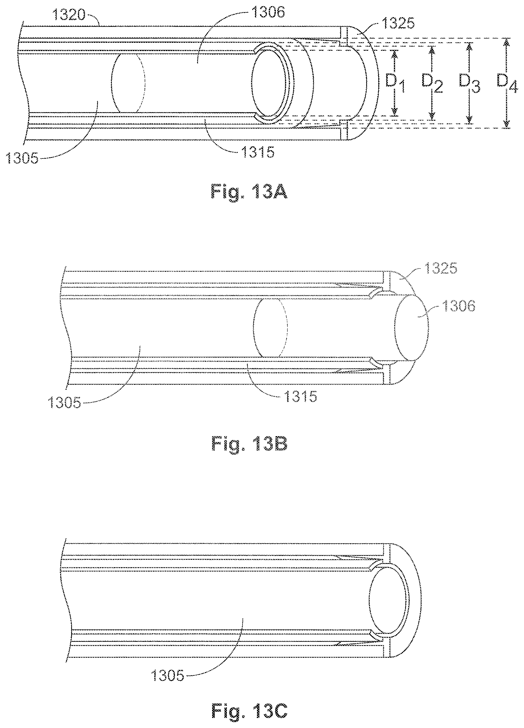 Patent US11771435 Figure 11 – Expandable implant and implant system