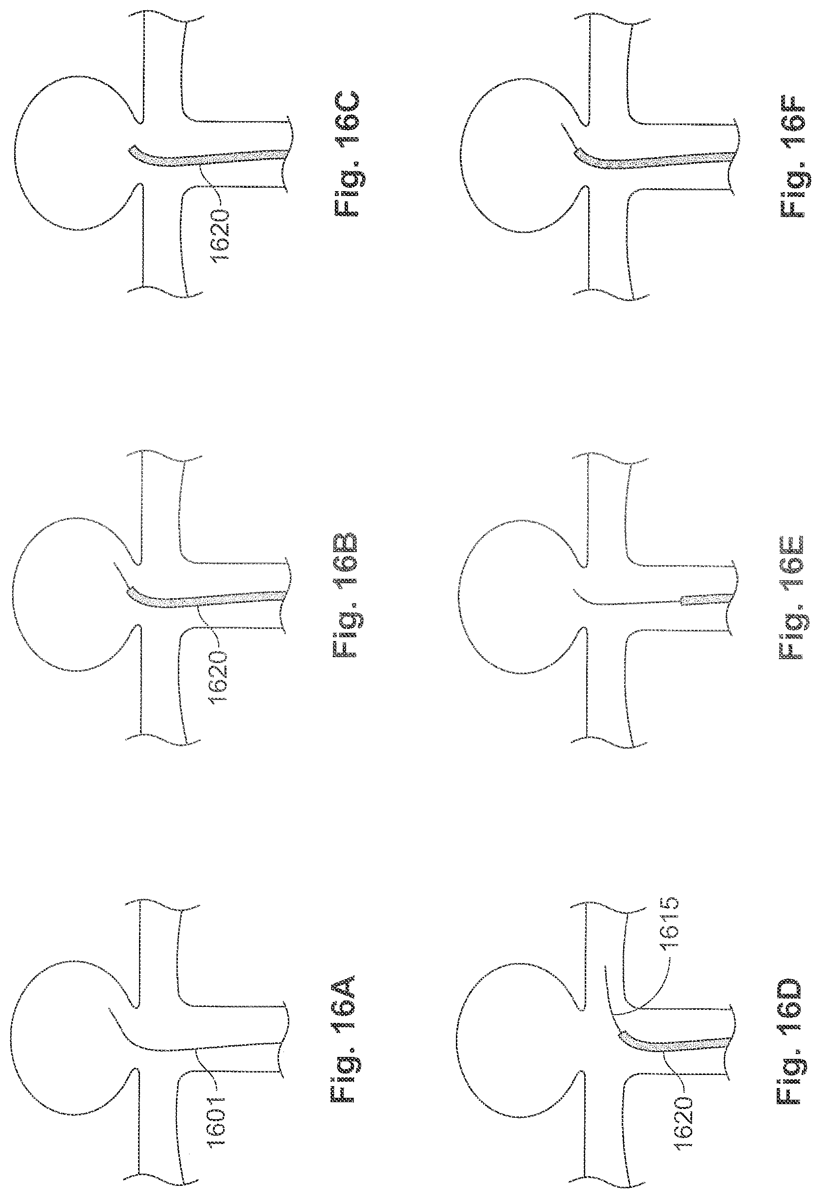 Patent US11771435 Figure 14 – Expandable implant and implant system