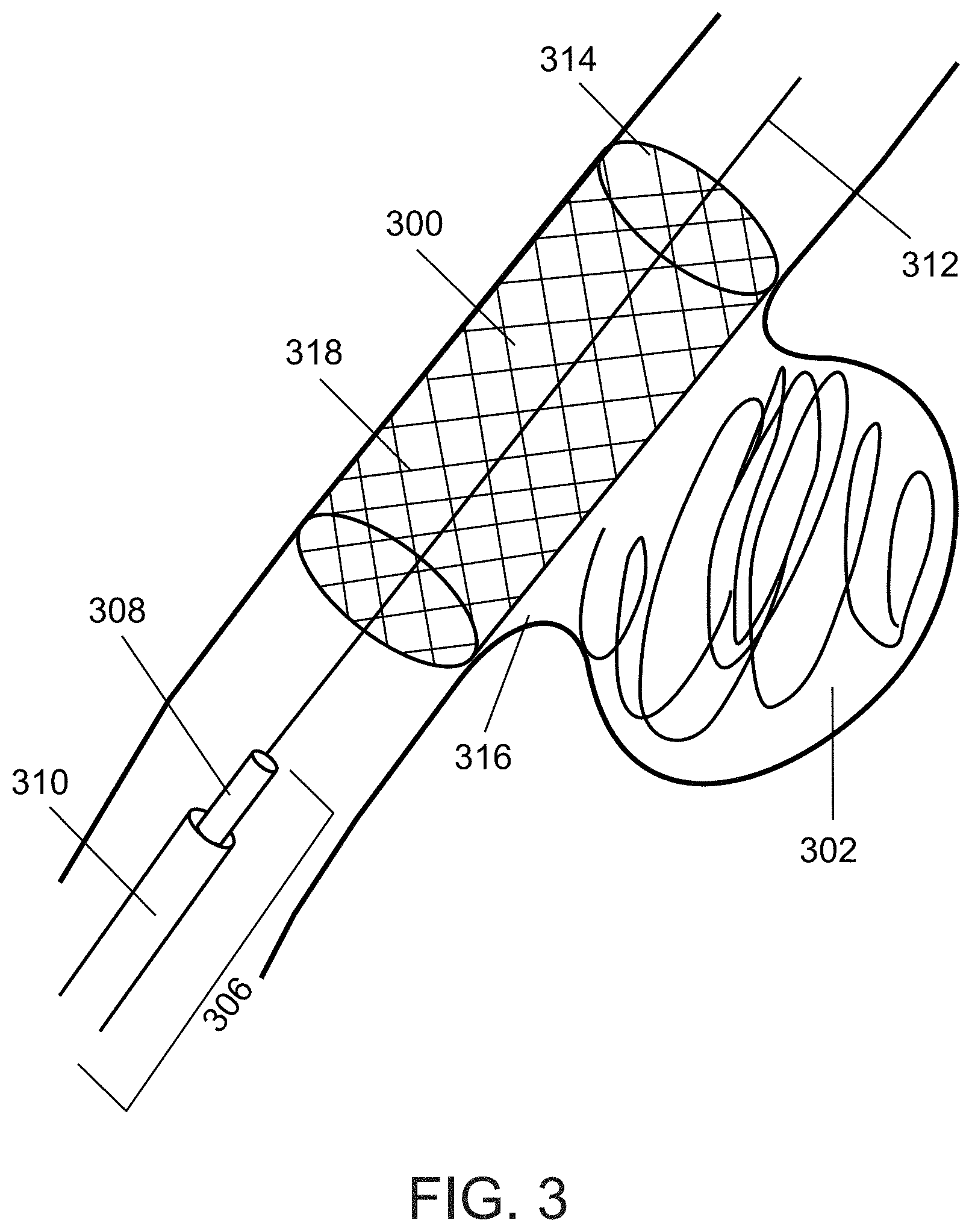 Patent US11771436 Figure 4 – Aneurysm treatment device and method
