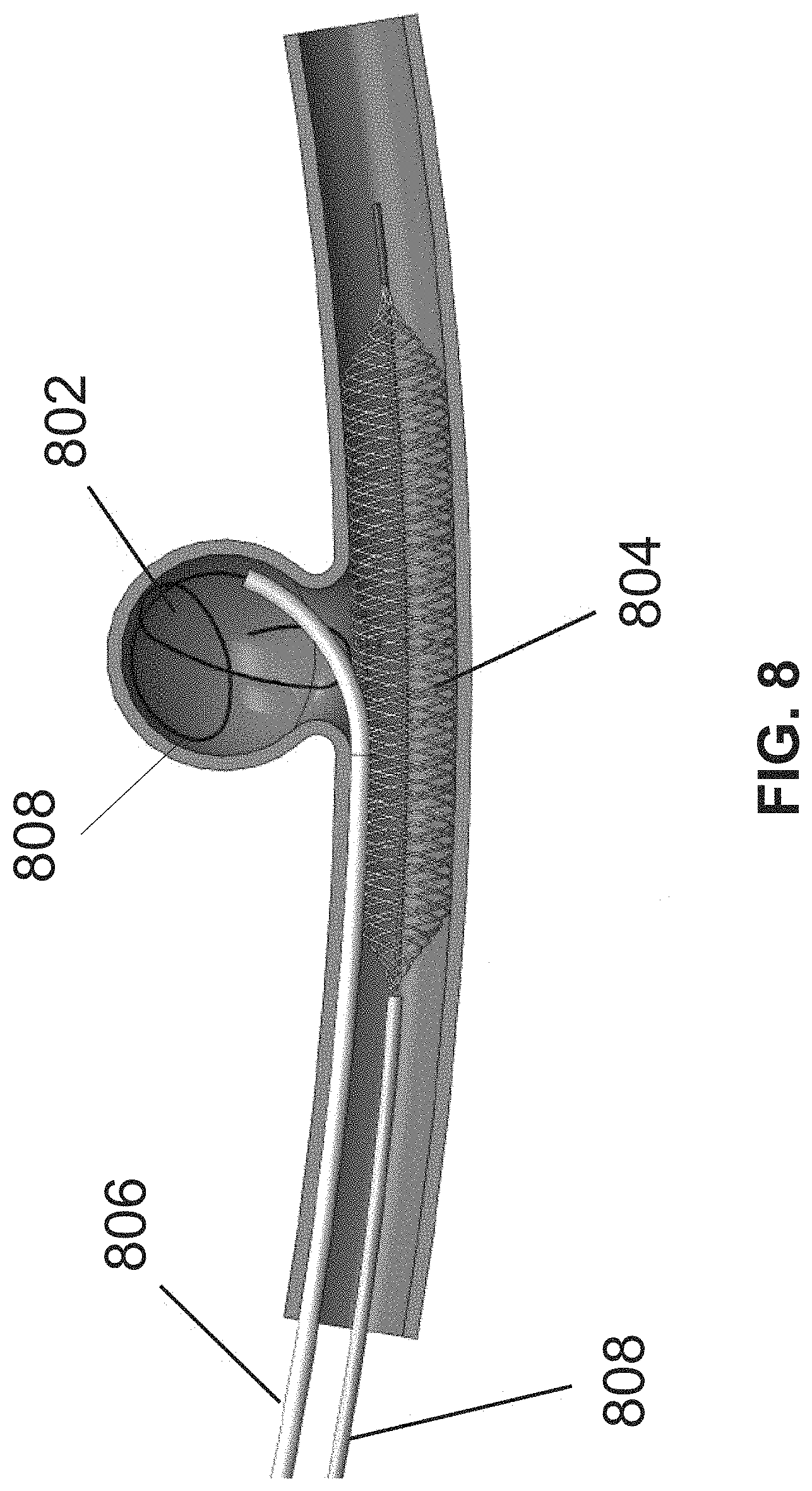Patent US11771436 Figure 12 – Aneurysm treatment device and method