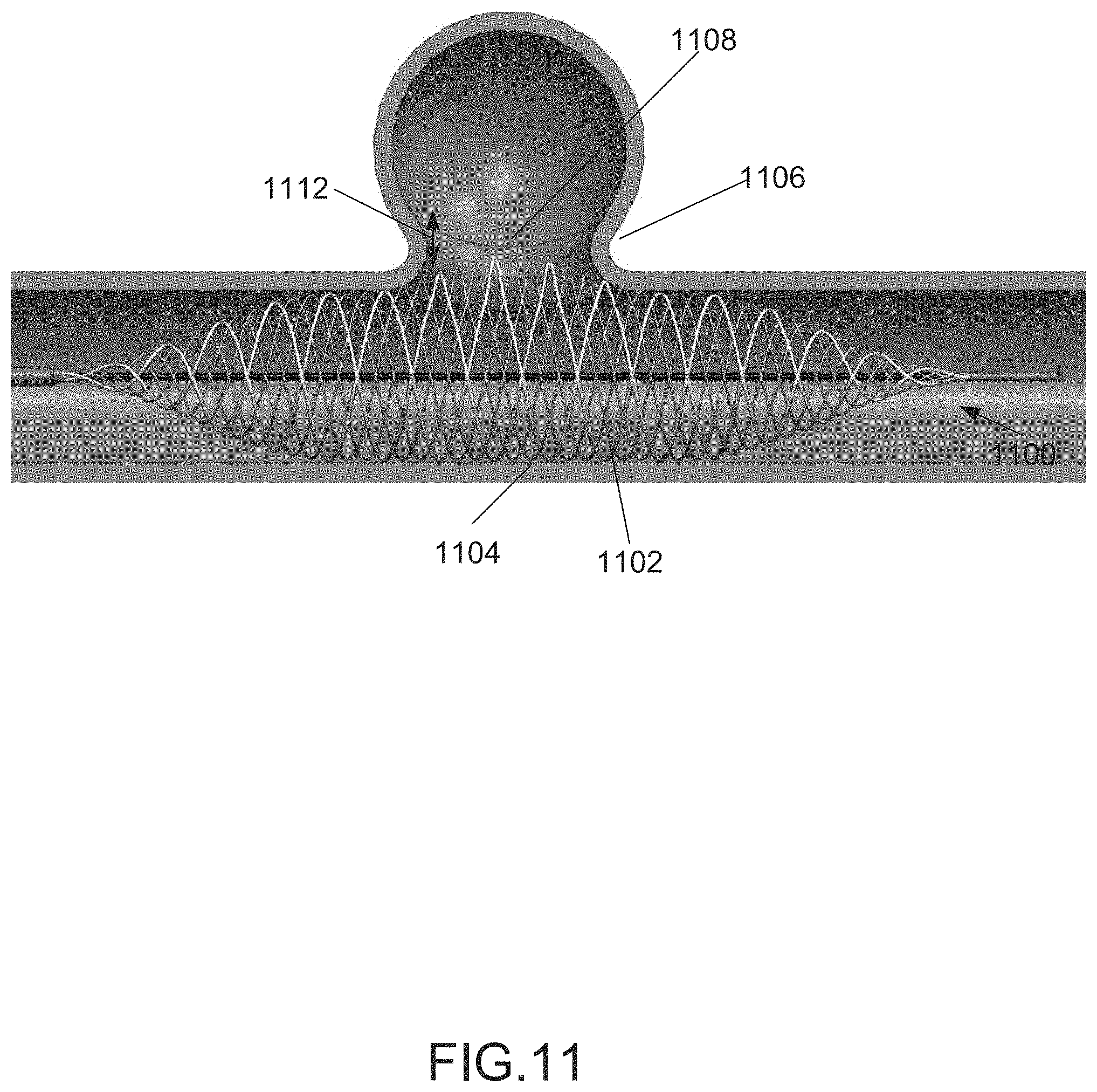 Patent US11771436 Figure 15 – Aneurysm treatment device and method
