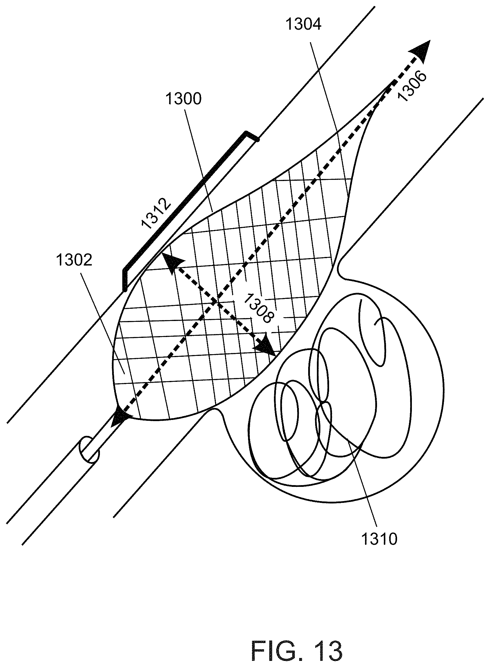 Patent US11771436 Figure 17 – Aneurysm treatment device and method